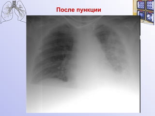 После пункции 