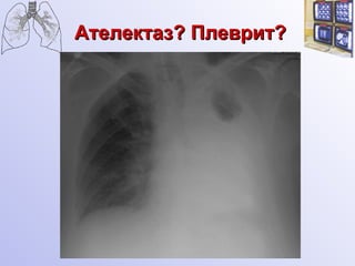 Ателектаз? Плеврит? 