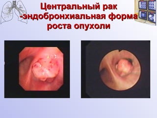 Центральный рак -эндобронхиальная форма роста опухоли 