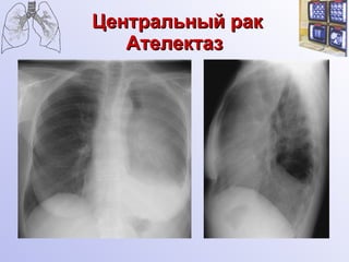 Центральный рак Ателектаз   