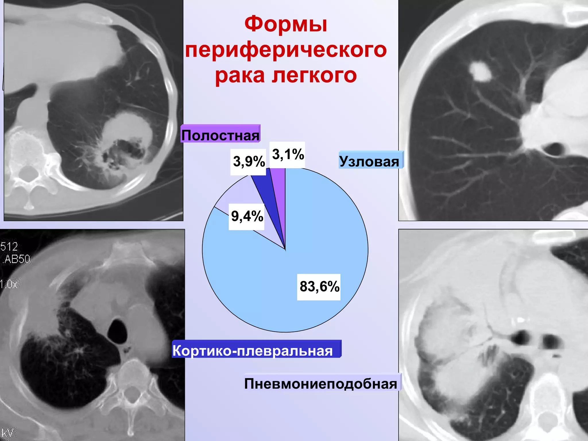 Формы периферического рака легкого Пневмониеподобная  Узловая  Кортико-плевральная  Полостная 