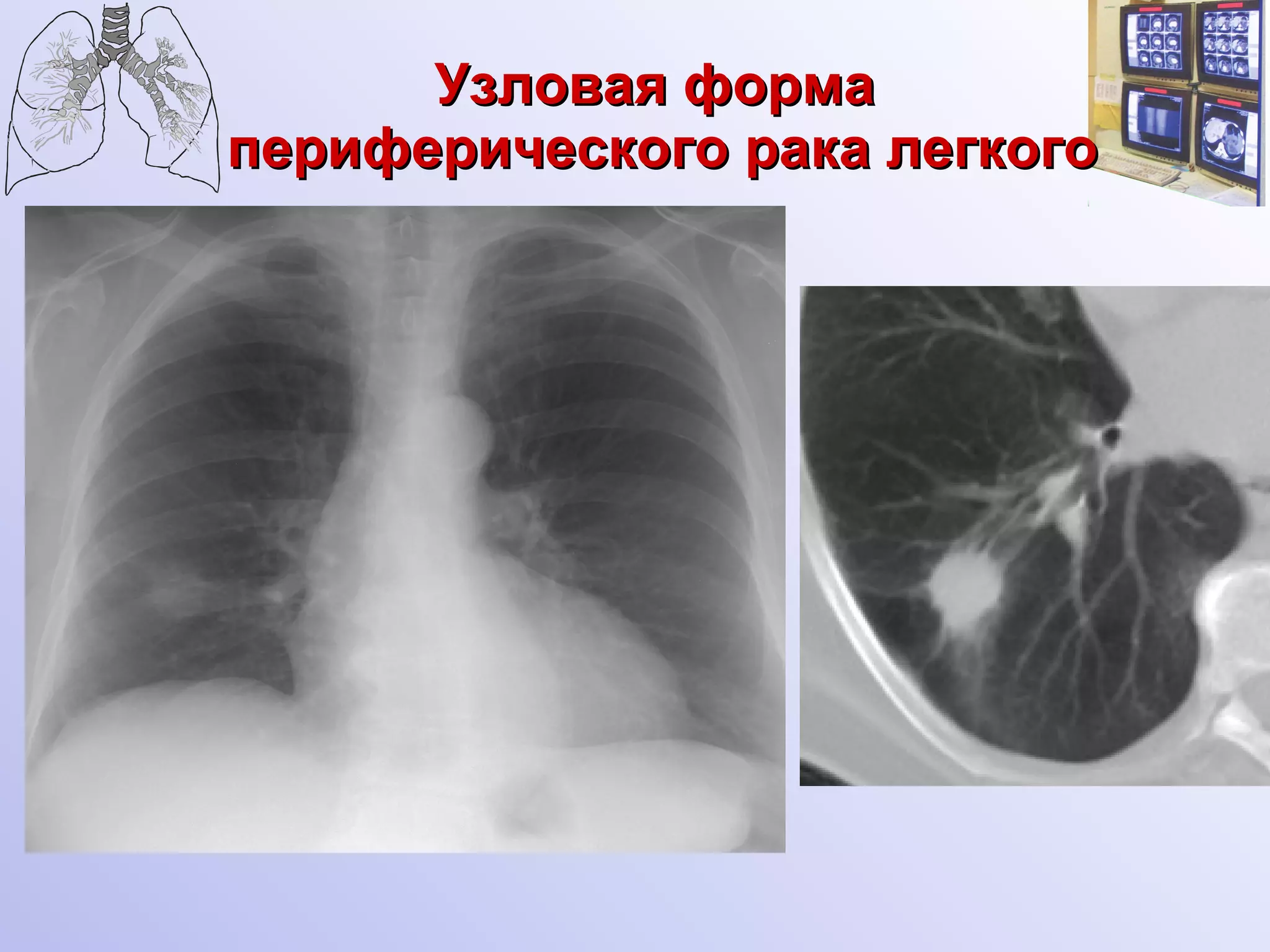 Узловая форма  периферического рака легкого 