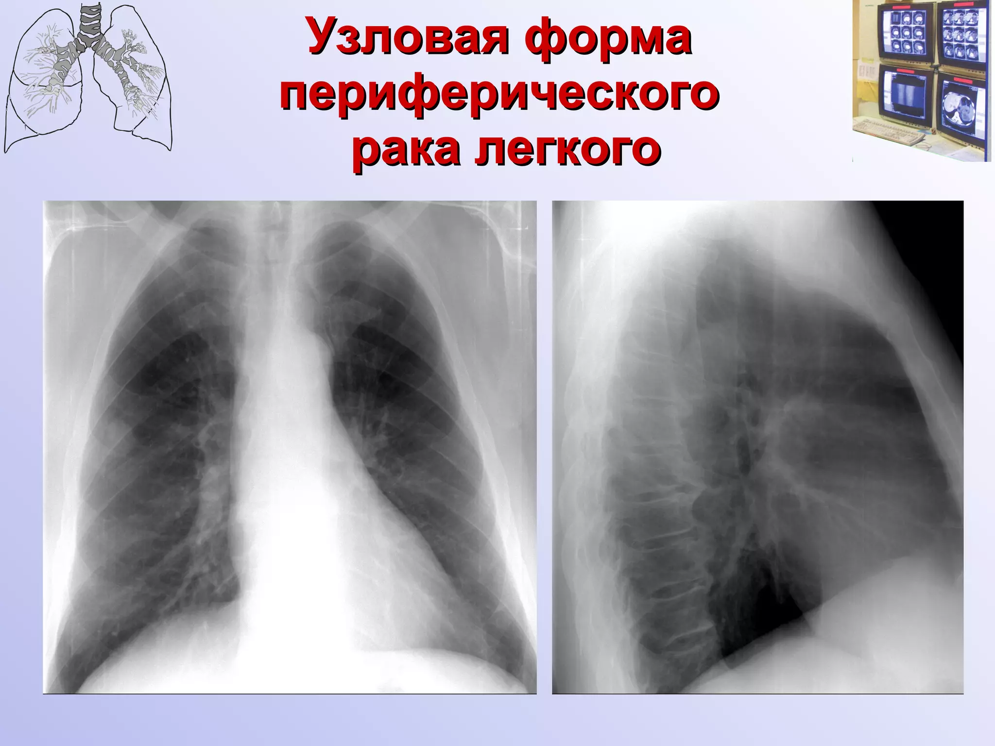 Узловая форма  периферического  рака легкого 