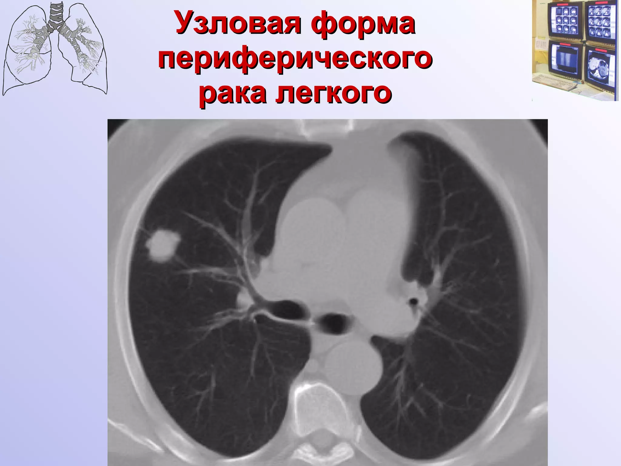 Узловая форма  периферического  рака легкого 