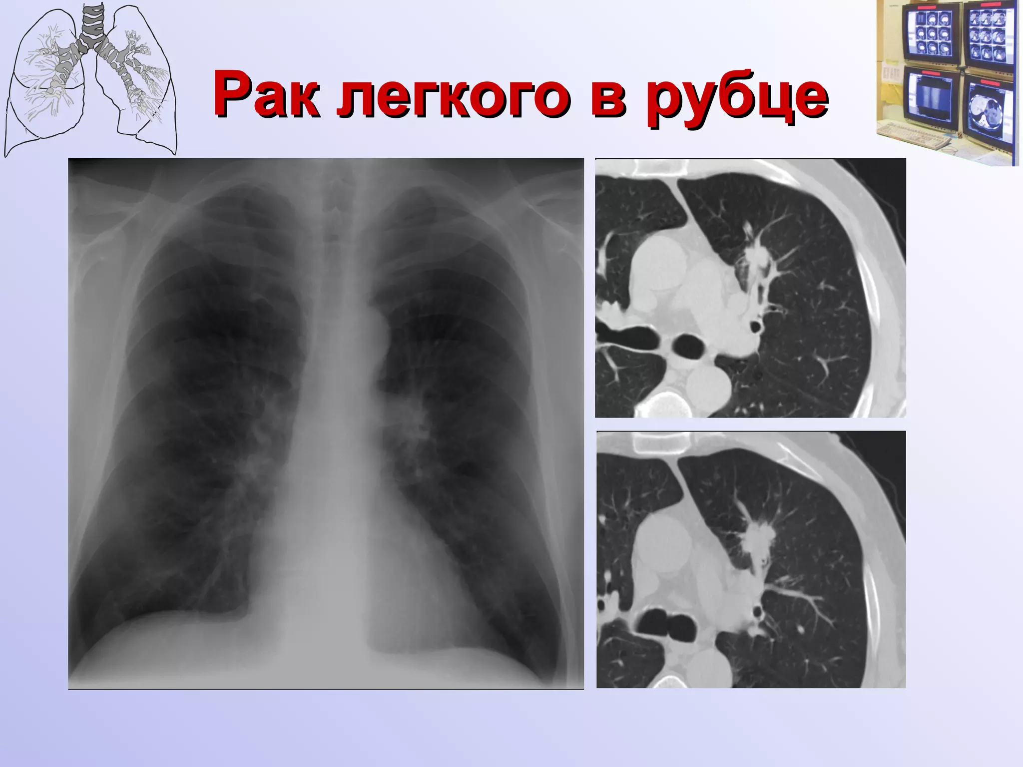 Рак легкого в рубце 