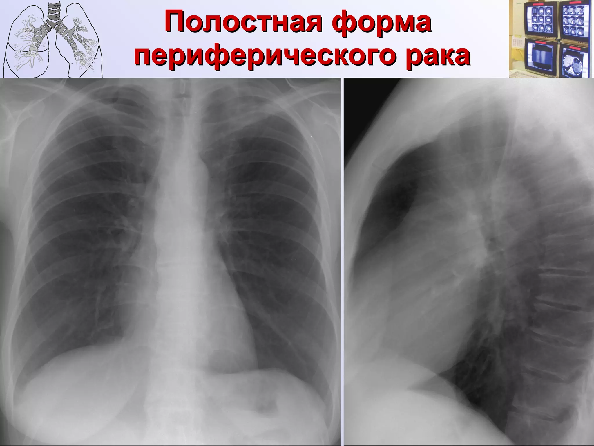 Полостная форма  периферического рака 