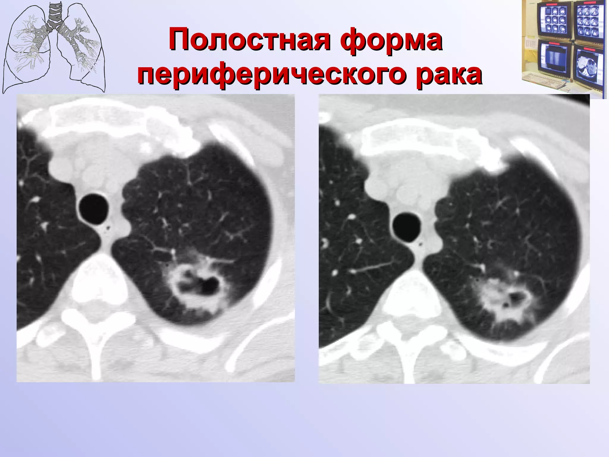 Полостная форма  периферического рака 