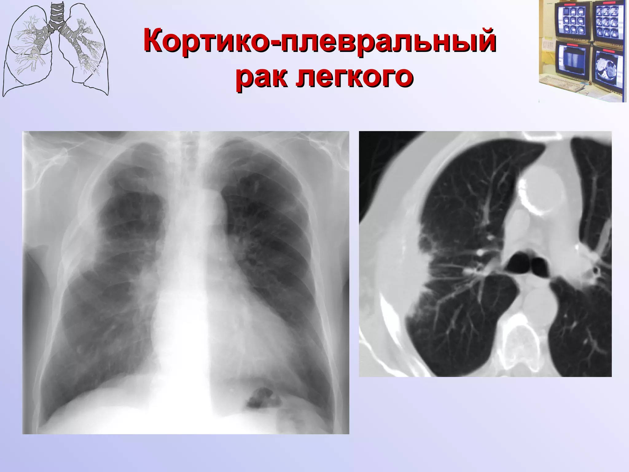 Кортико-плевральный  рак легкого 