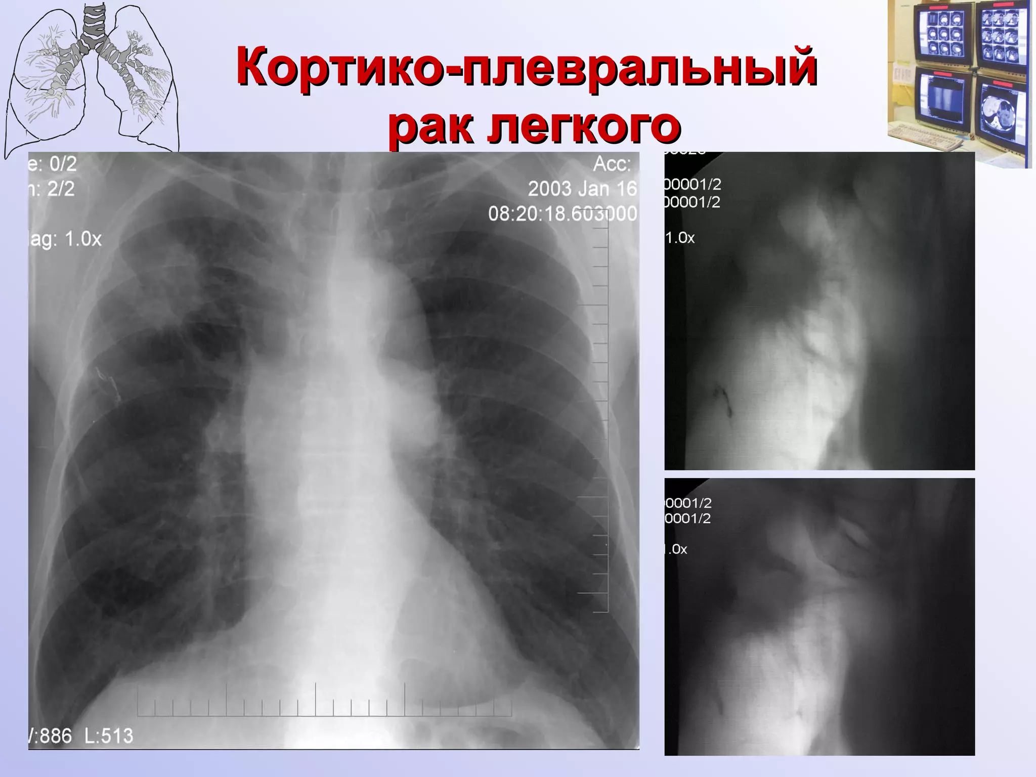 Кортико-плевральный  рак легкого 