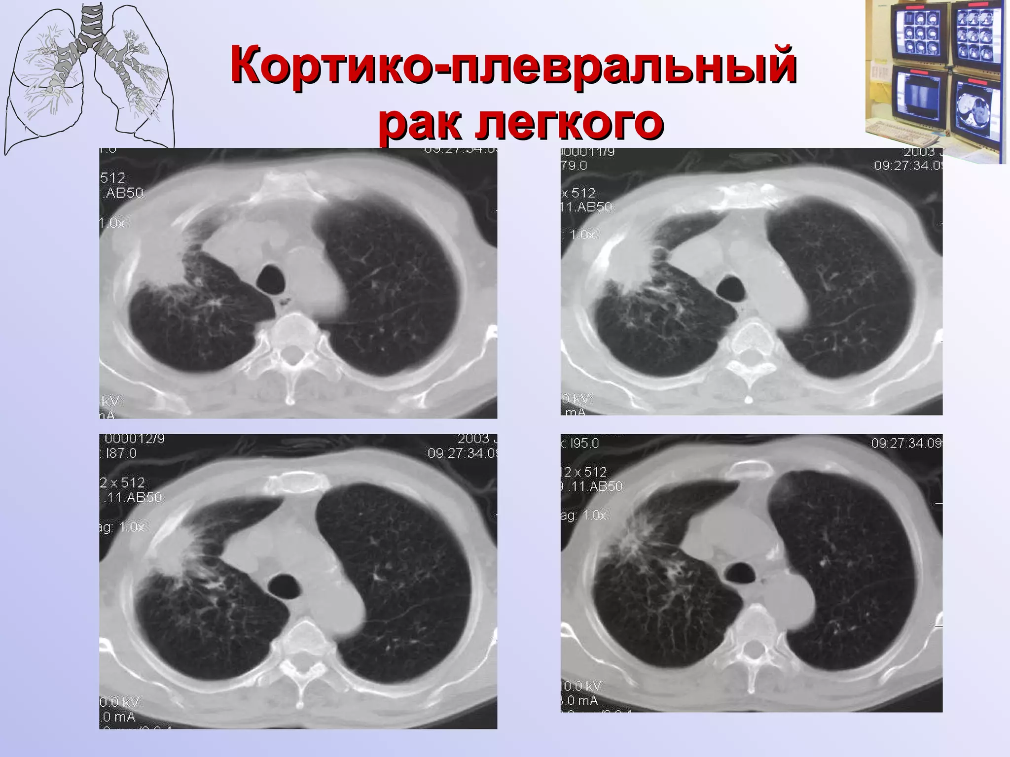 Кортико-плевральный  рак легкого 