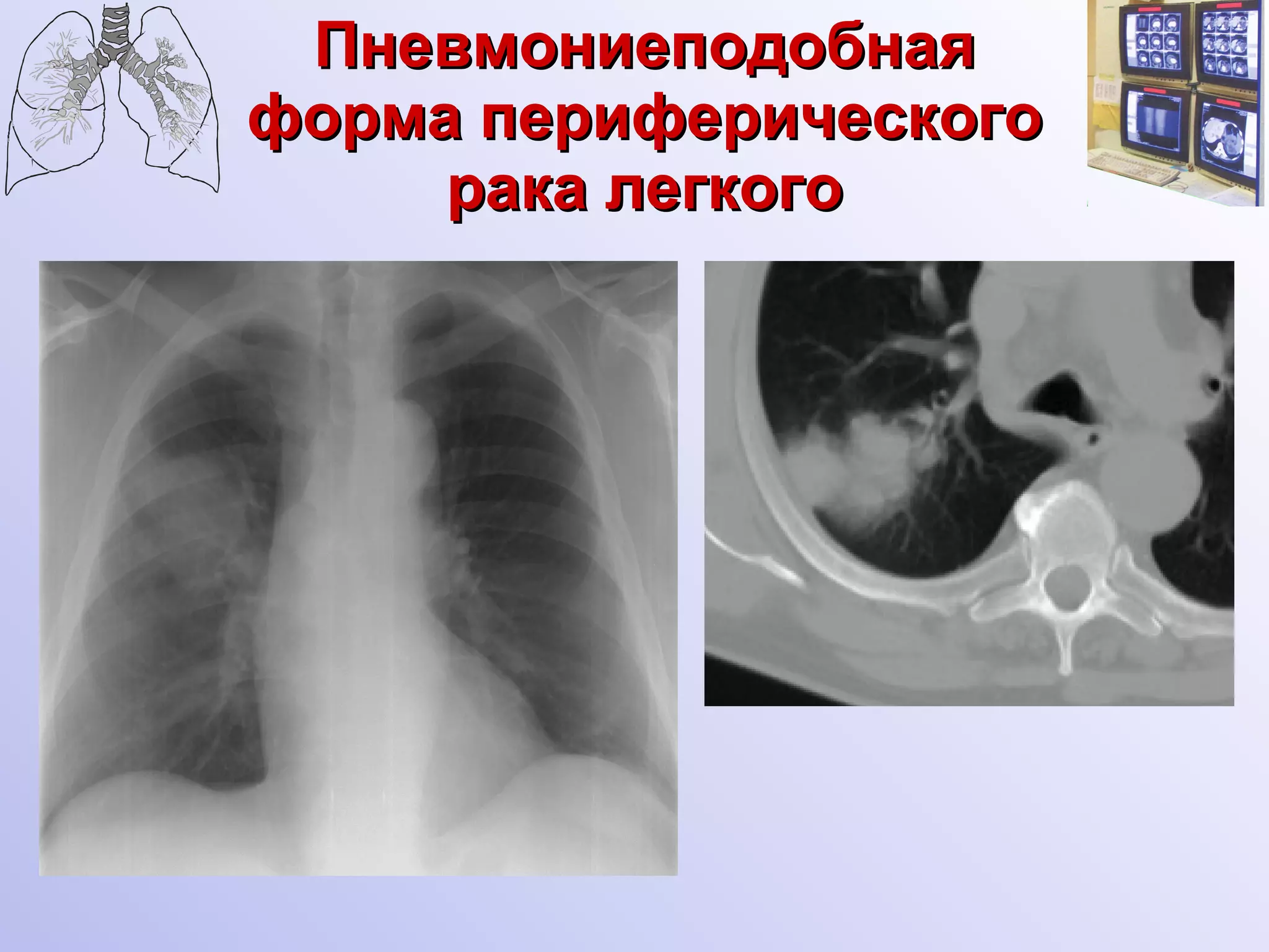 Пневмониеподобная форма периферического рака легкого 