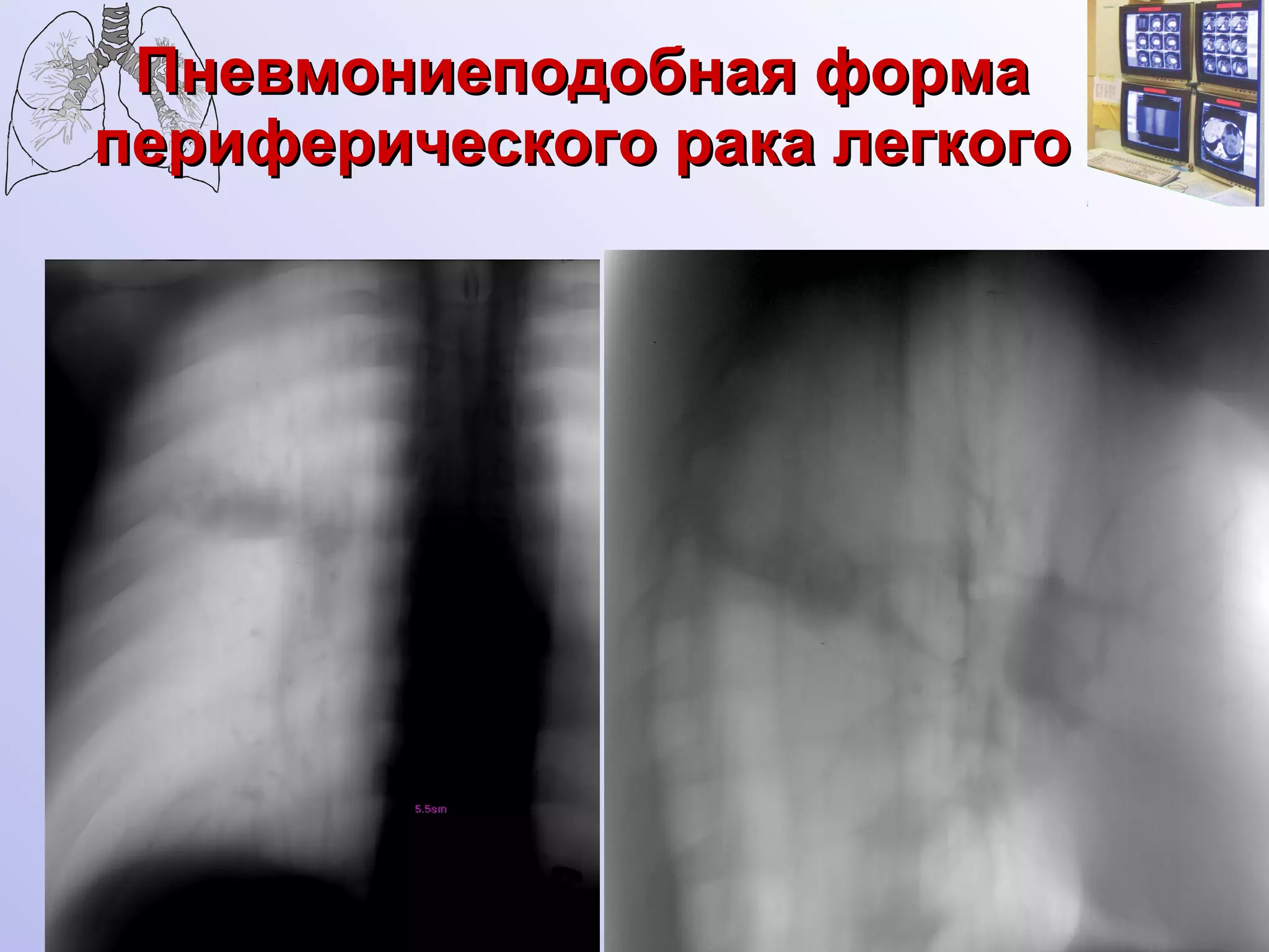 Пневмониеподобная форма периферического рака легкого 