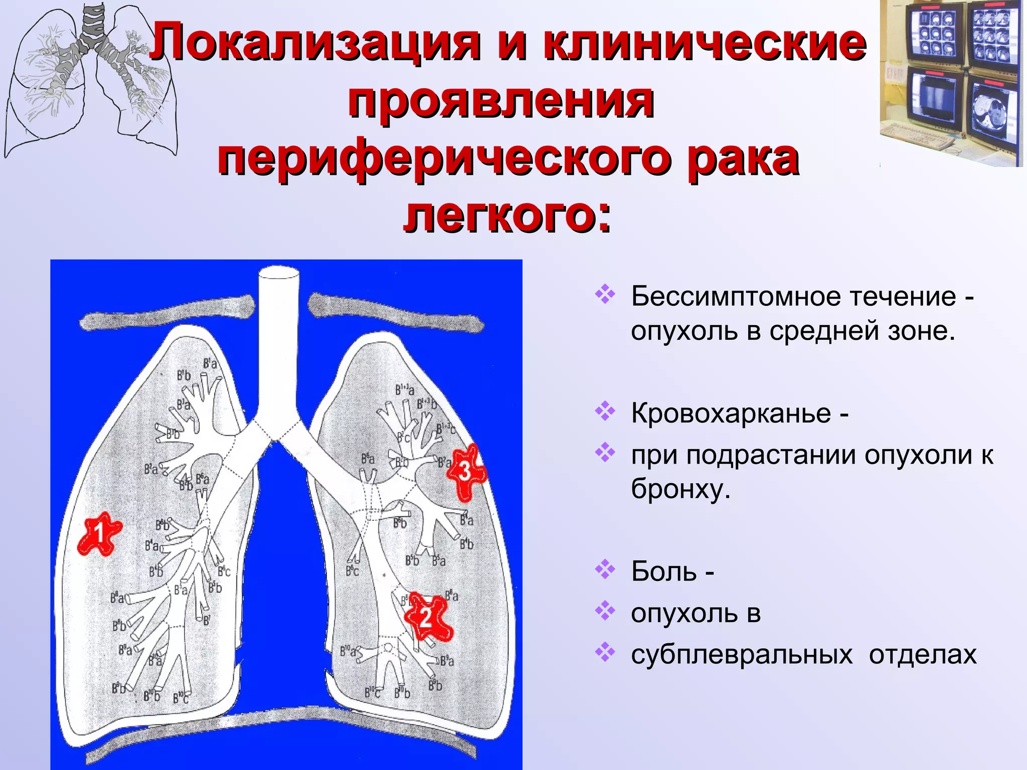 Локализация и клинические проявления  периферического рака легкого: Бессимптомное течение - опухоль в средней зоне. Кровохарканье - при подрастании опухоли к бронху. Боль - опухоль в субплевральных  отделах 