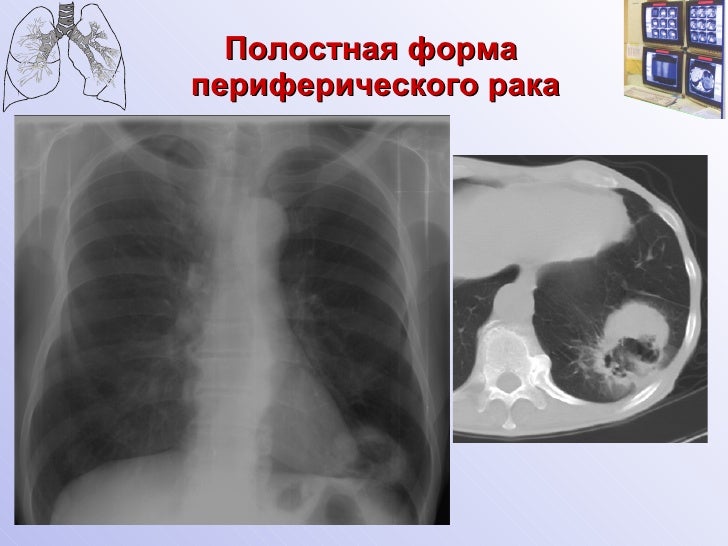 полостной рак легкого. периферическое заболевание легкого что это. опухоль с неровными контурами. шаровидные образования легких кт. полостной рак легкого.