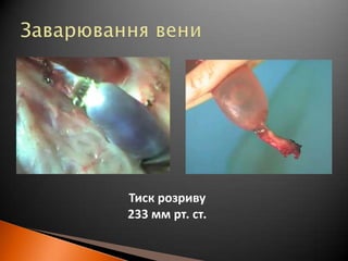 Заварювання вениТиск розриву233 мм рт. ст.