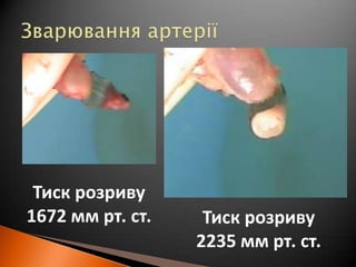Зварювання артеріїТискрозриву1672 мм рт. ст.Тискрозриву2235 мм рт. ст.