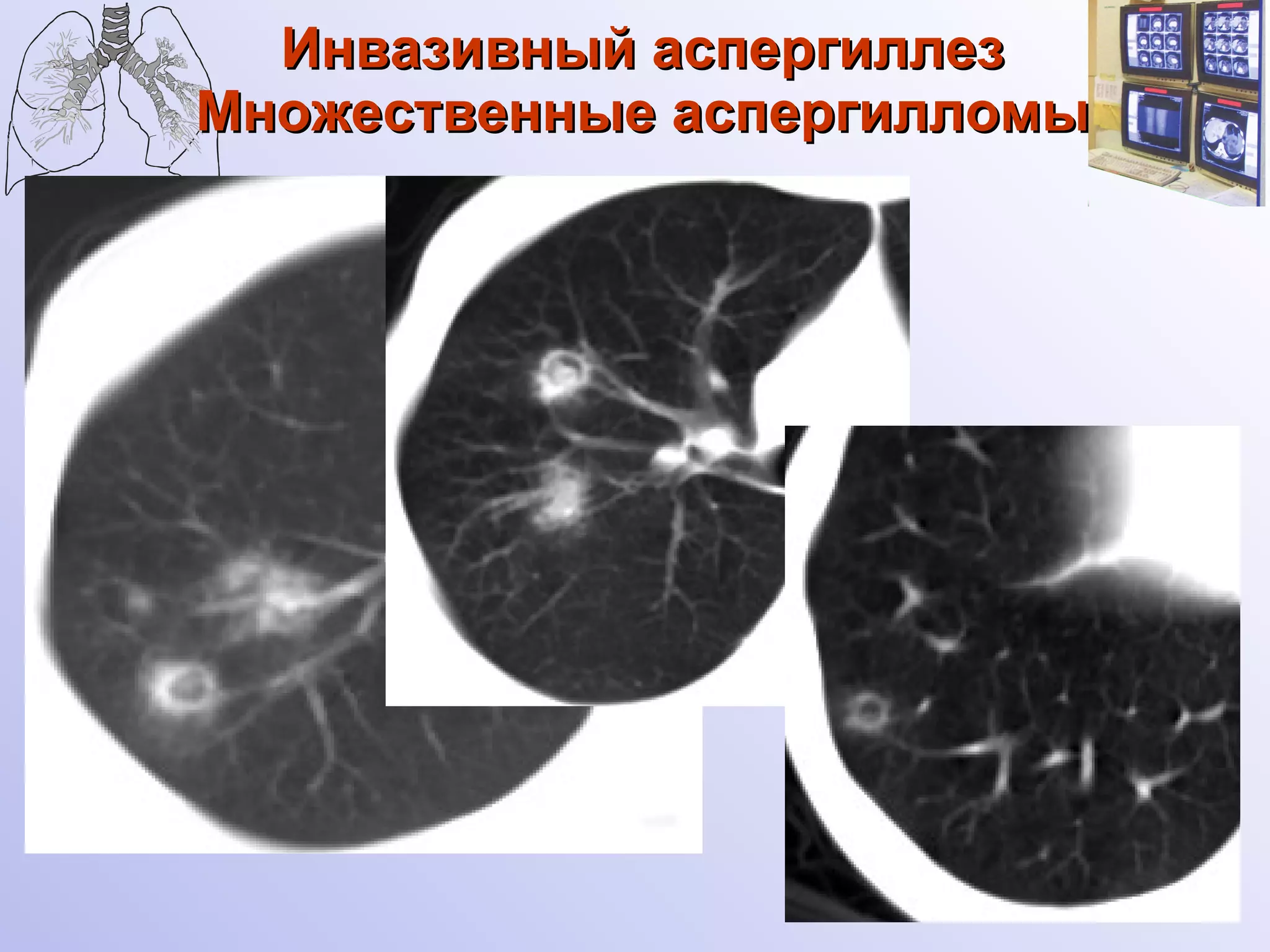 Инвазивный аспергиллез Множественные аспергилломы 