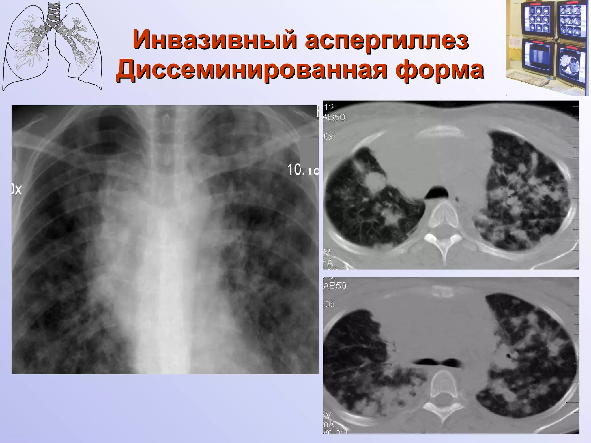 Инвазивный аспергиллез Диссеминированная форма 