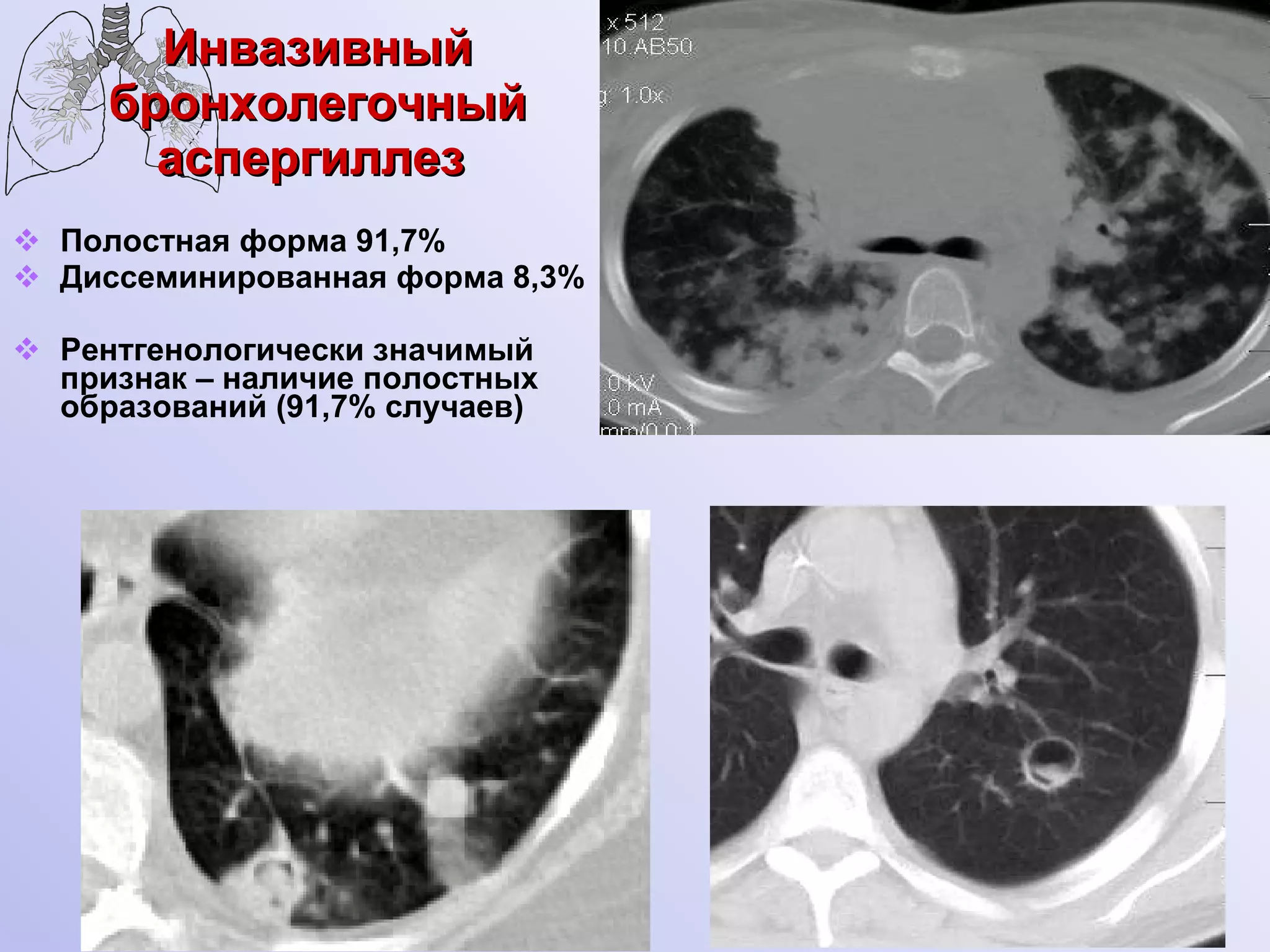 Инвазивный бронхолегочный аспергиллез  Полостная форма 91,7% Диссеминированная форма 8,3% Рентгенологически значимый признак –   наличие полостных образований ( 91,7%  случаев) 