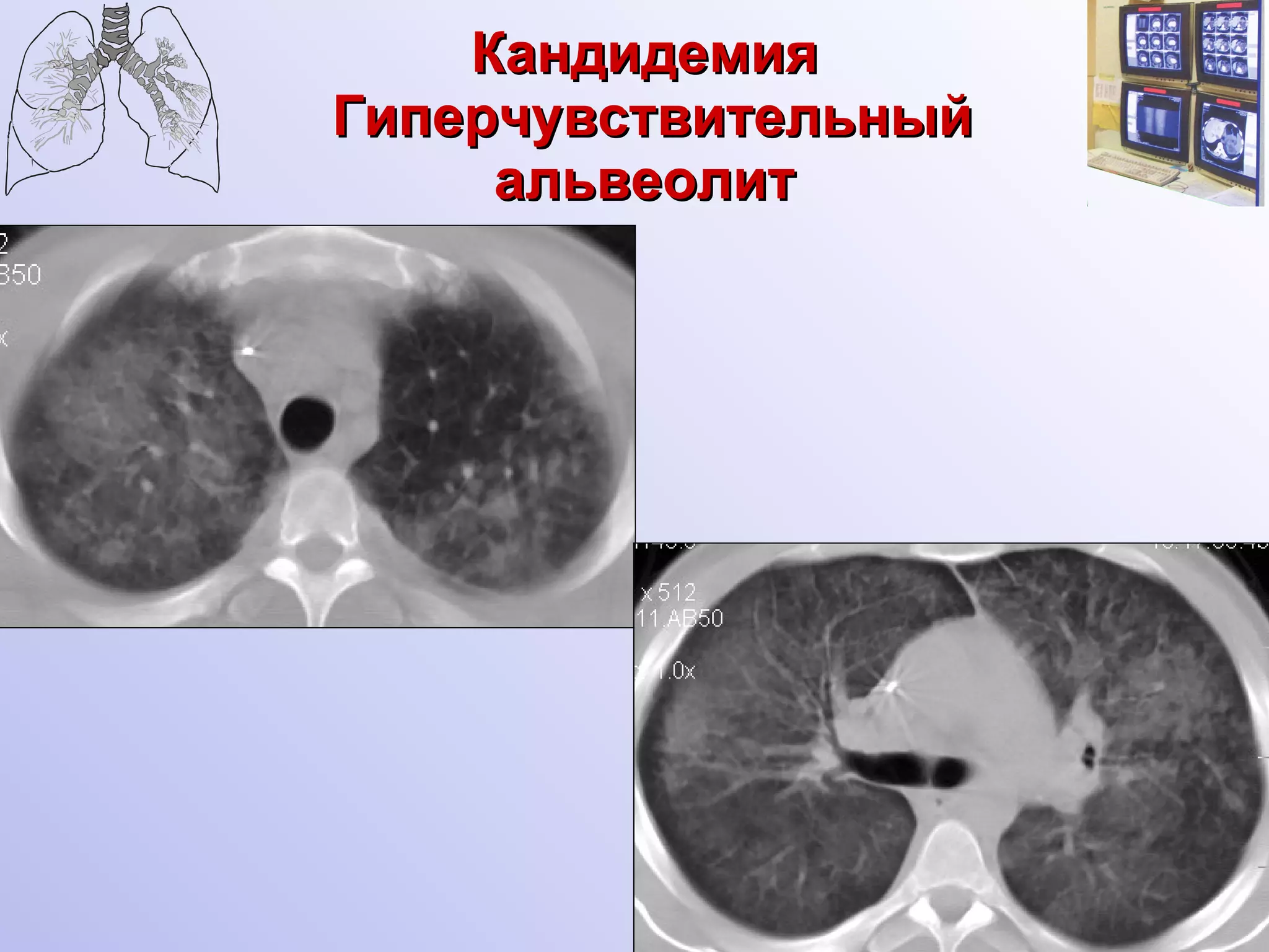 Кандидемия  Гиперчувствительный альвеолит 