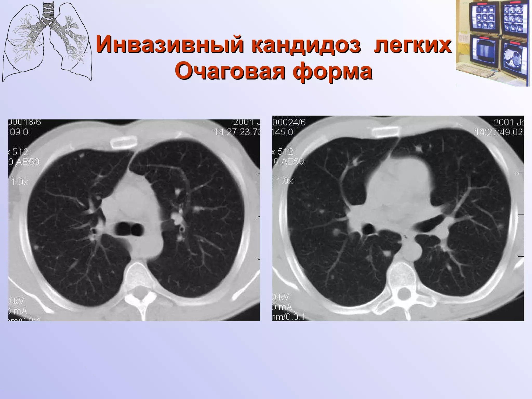 Инвазивный кандидоз  легких Очаговая форма 