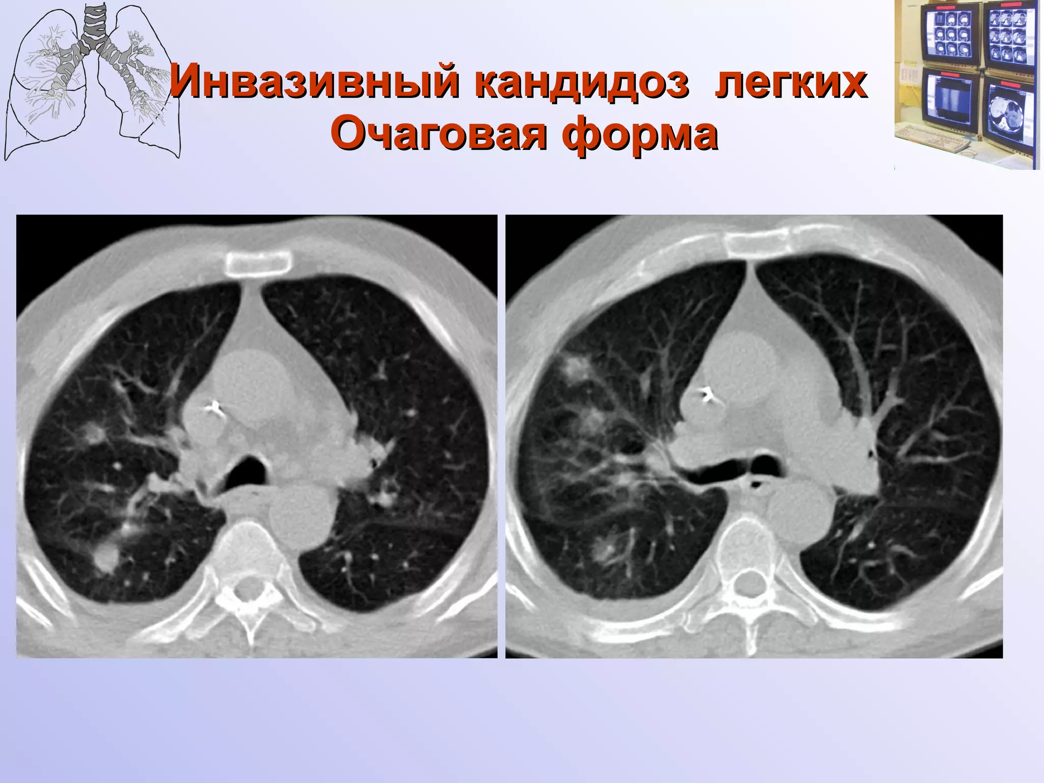 Инвазивный кандидоз  легких  Очаговая форма 