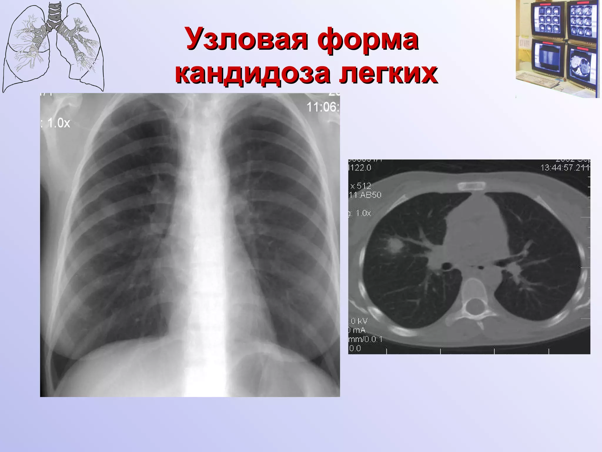 Узловая форма  кандидоза легких 