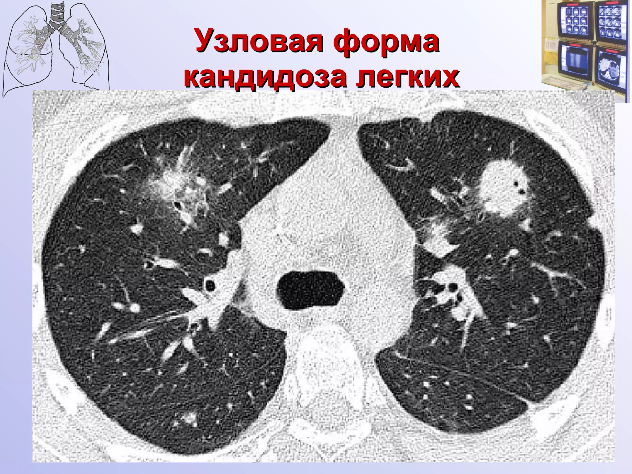 Узловая форма  кандидоза легких 