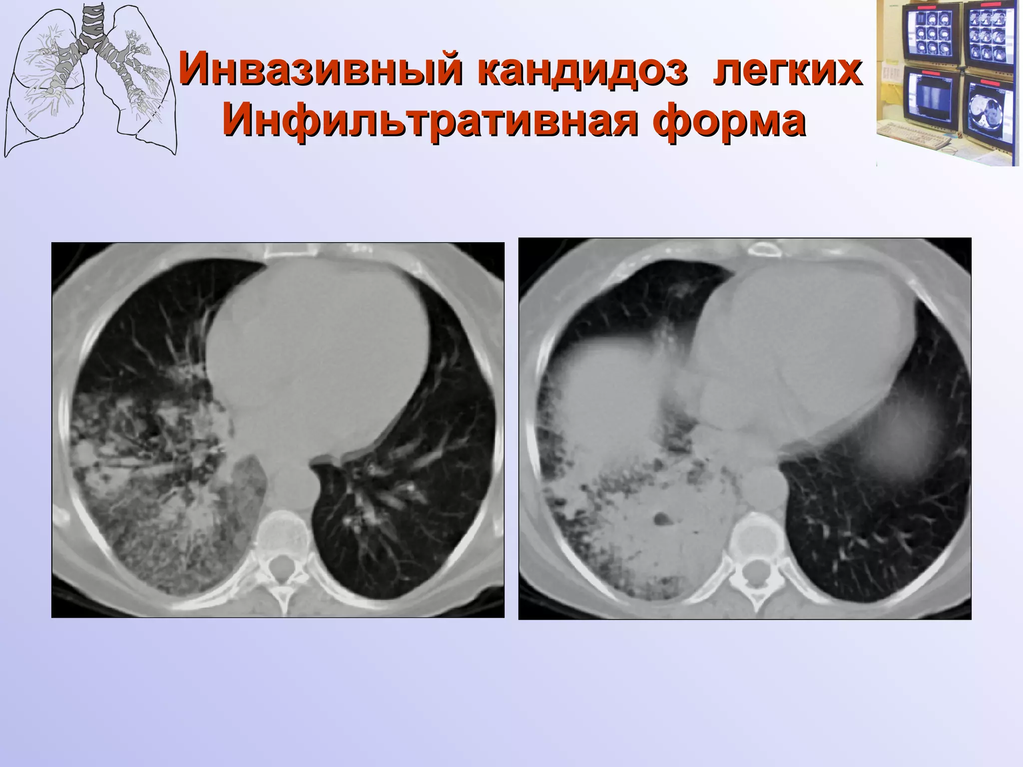 Инвазивный кандидоз  легких Инфильтративная форма   