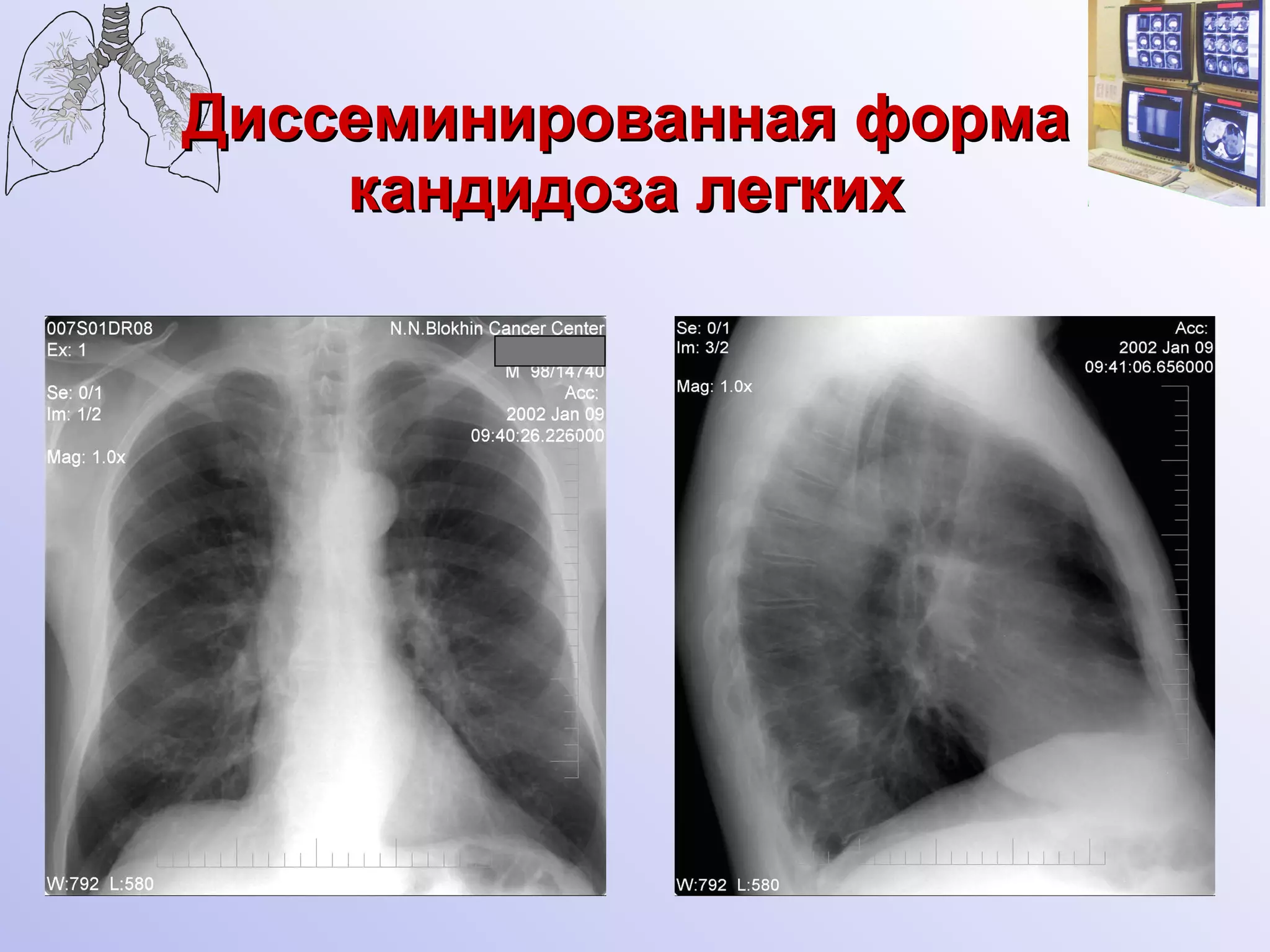 Диссеминированная форма кандидоза легких 