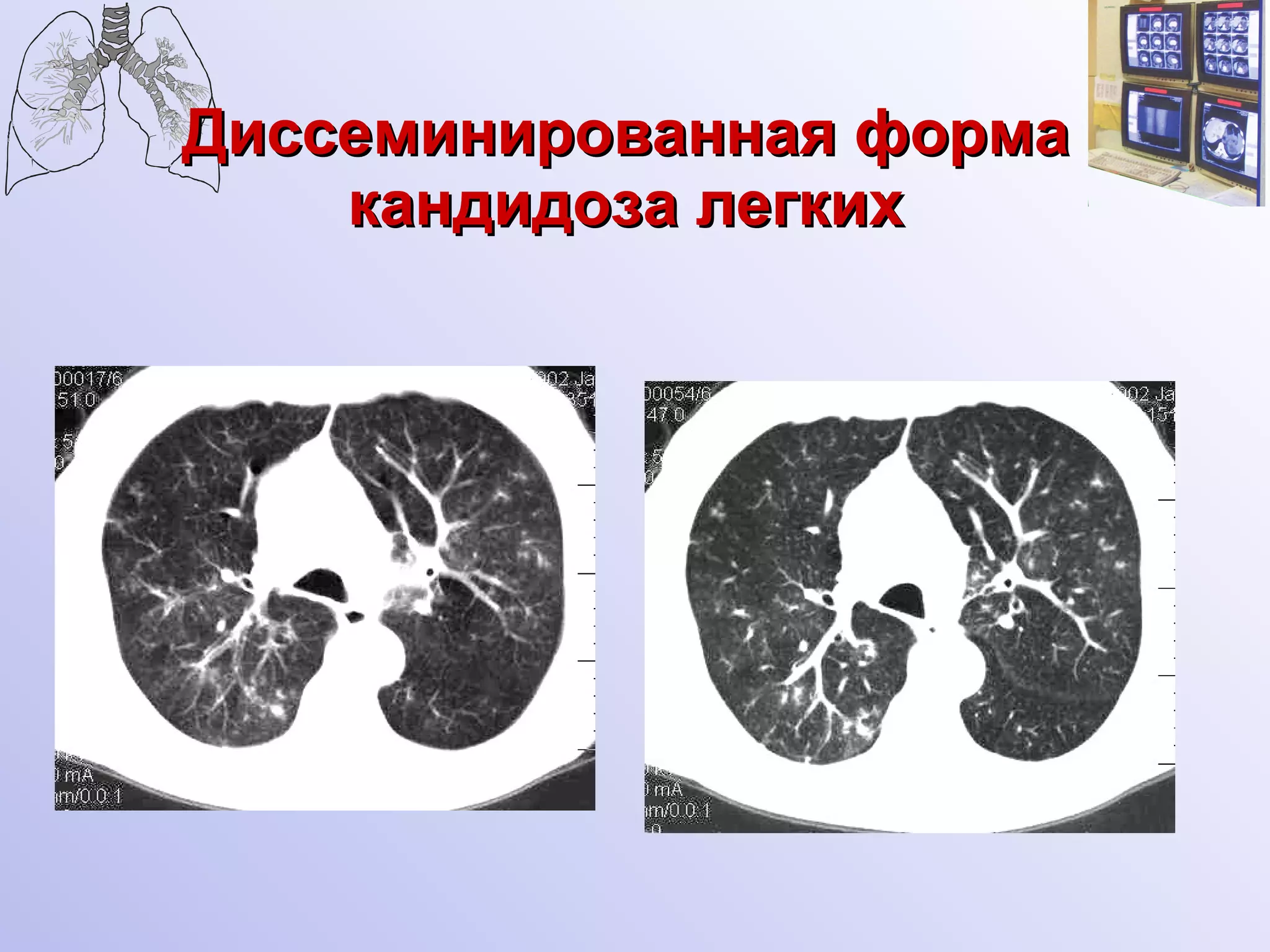 Диссеминированная форма кандидоза легких 