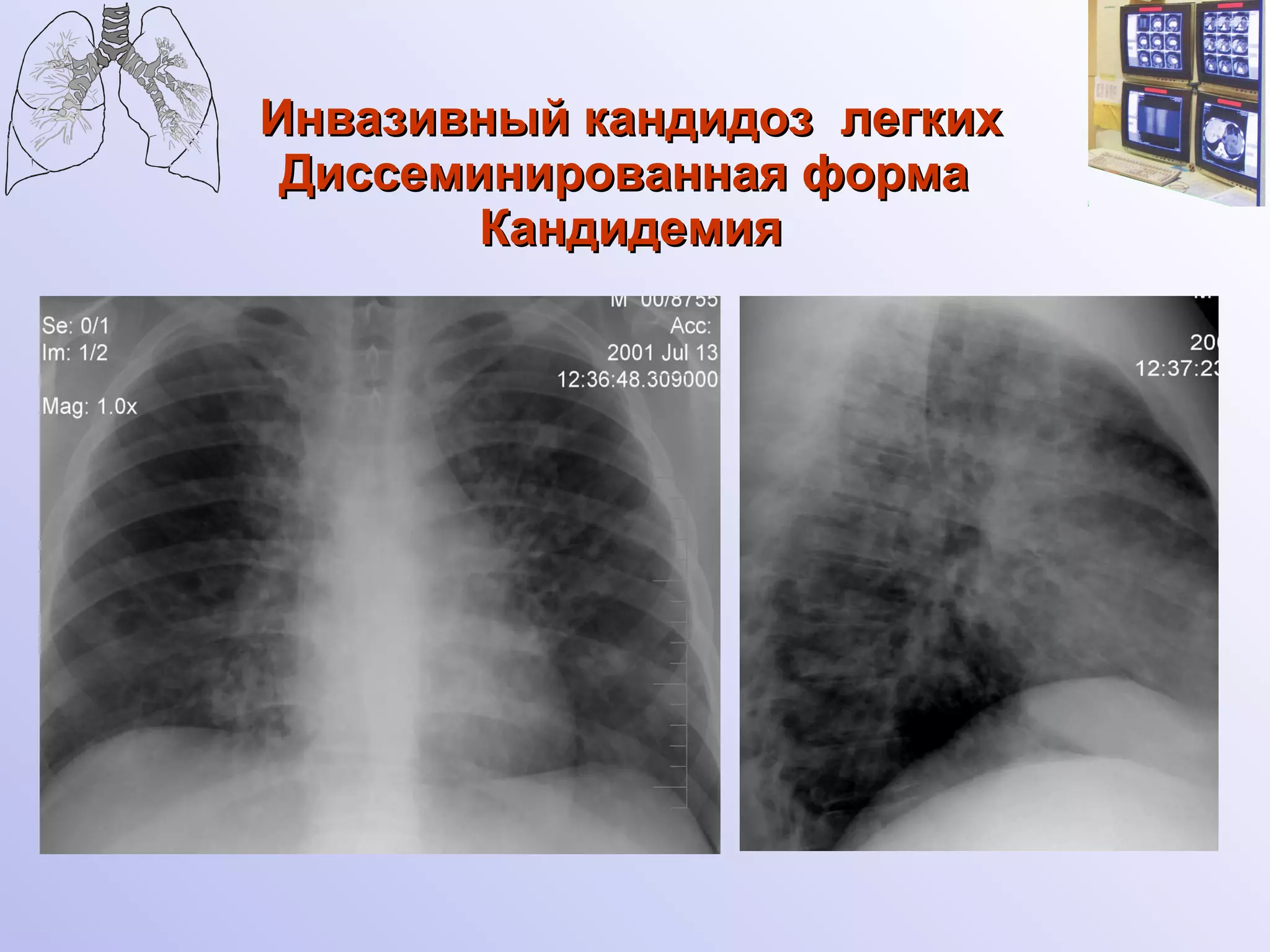 Инвазивный кандидоз  легких Диссеминированная форма  Кандидемия 