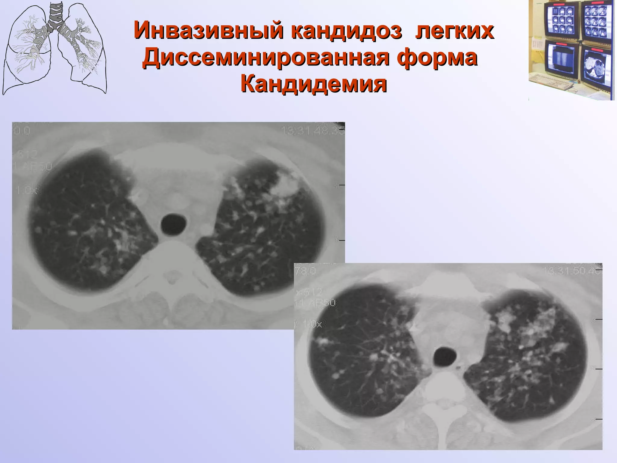 Инвазивный кандидоз  легких Диссеминированная форма  Кандидемия 