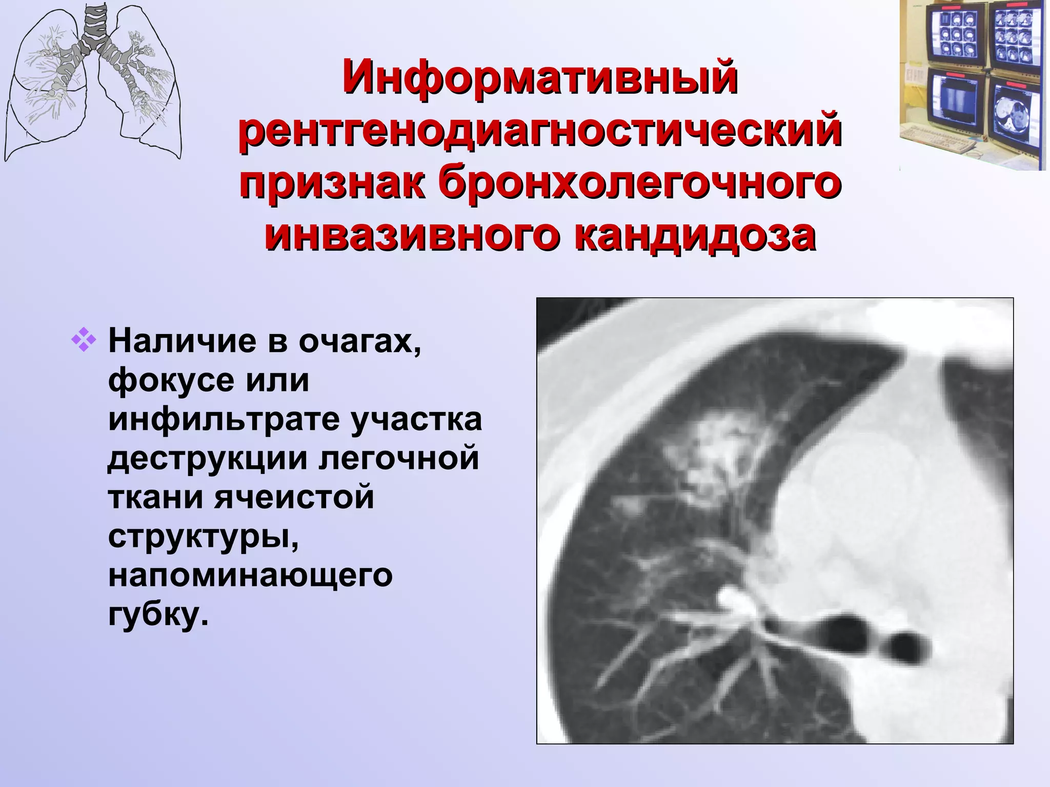 Информативный рентгенодиагностический признак бронхолегочного инвазивного кандидоза Наличие в очагах, фокусе или инфильтрате участка деструкции легочной ткани ячеистой структуры, напоминающего губку. 