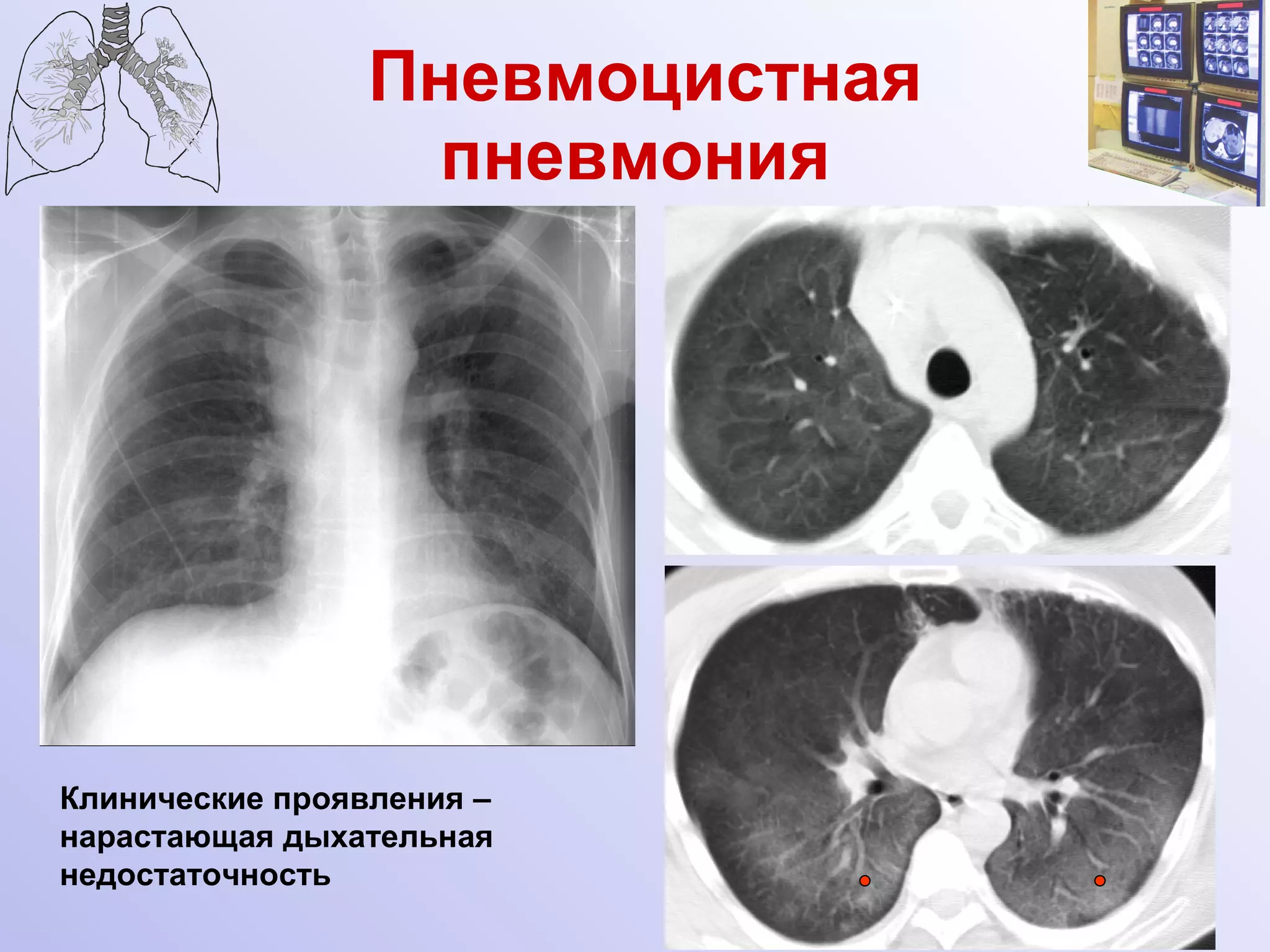 Пневмоцистная пневмония  Клинические проявления – нарастающая дыхательная недостаточность 