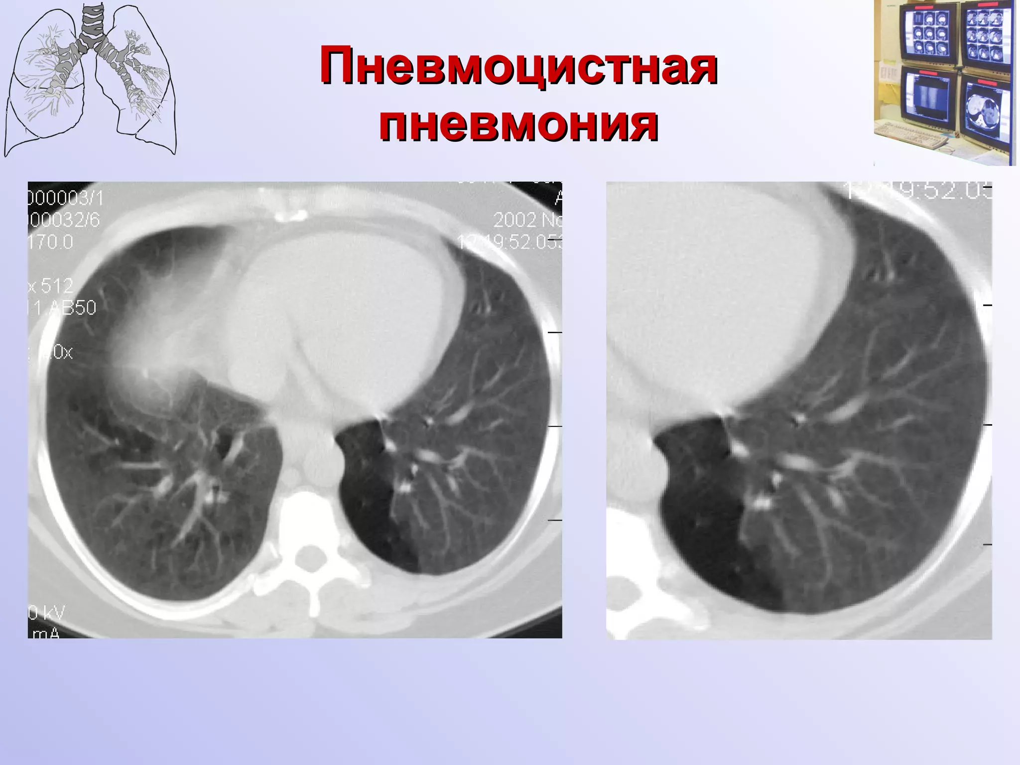 Пневмоцистная пневмония 
