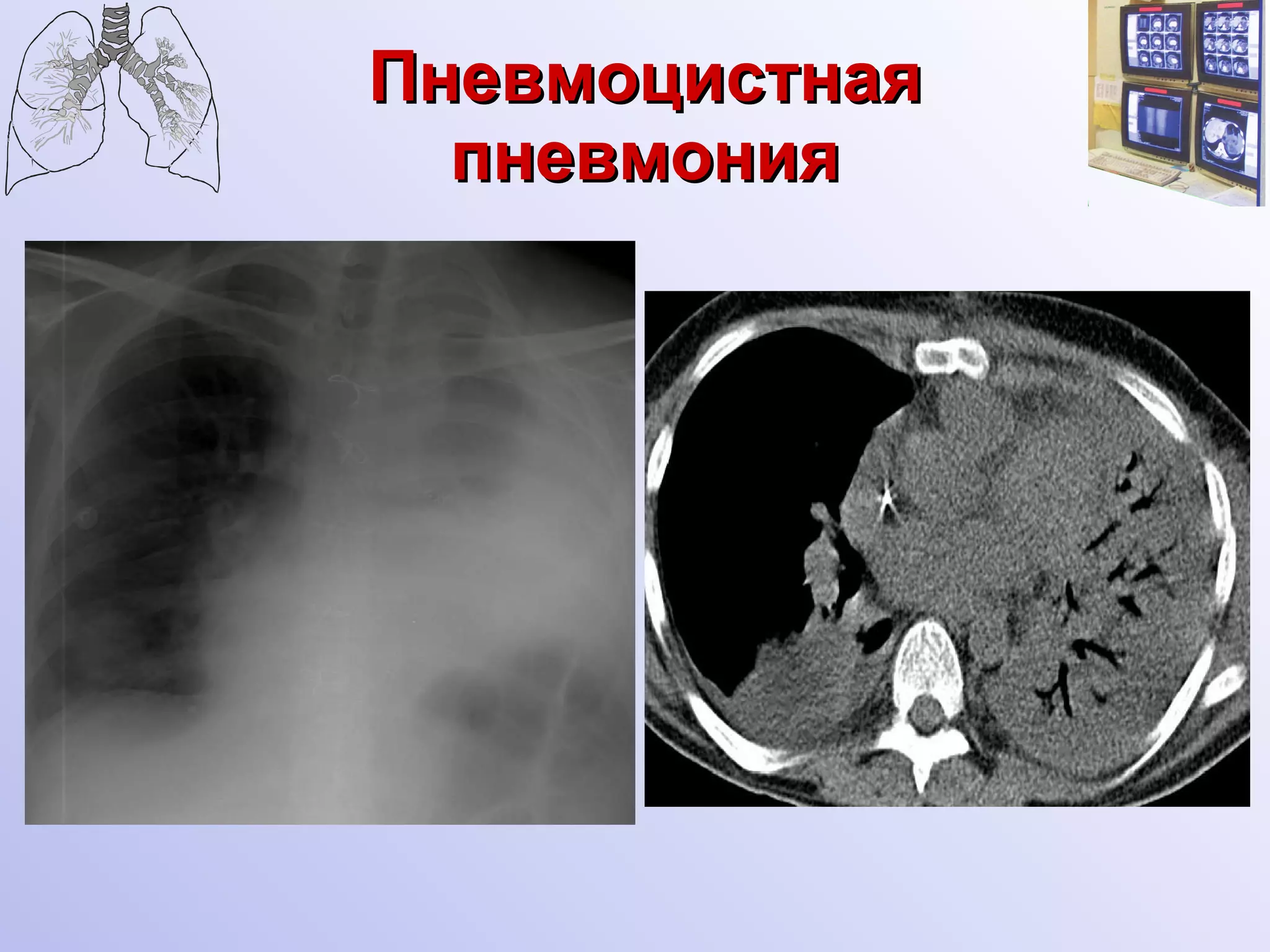 Пневмоцистная пневмония 