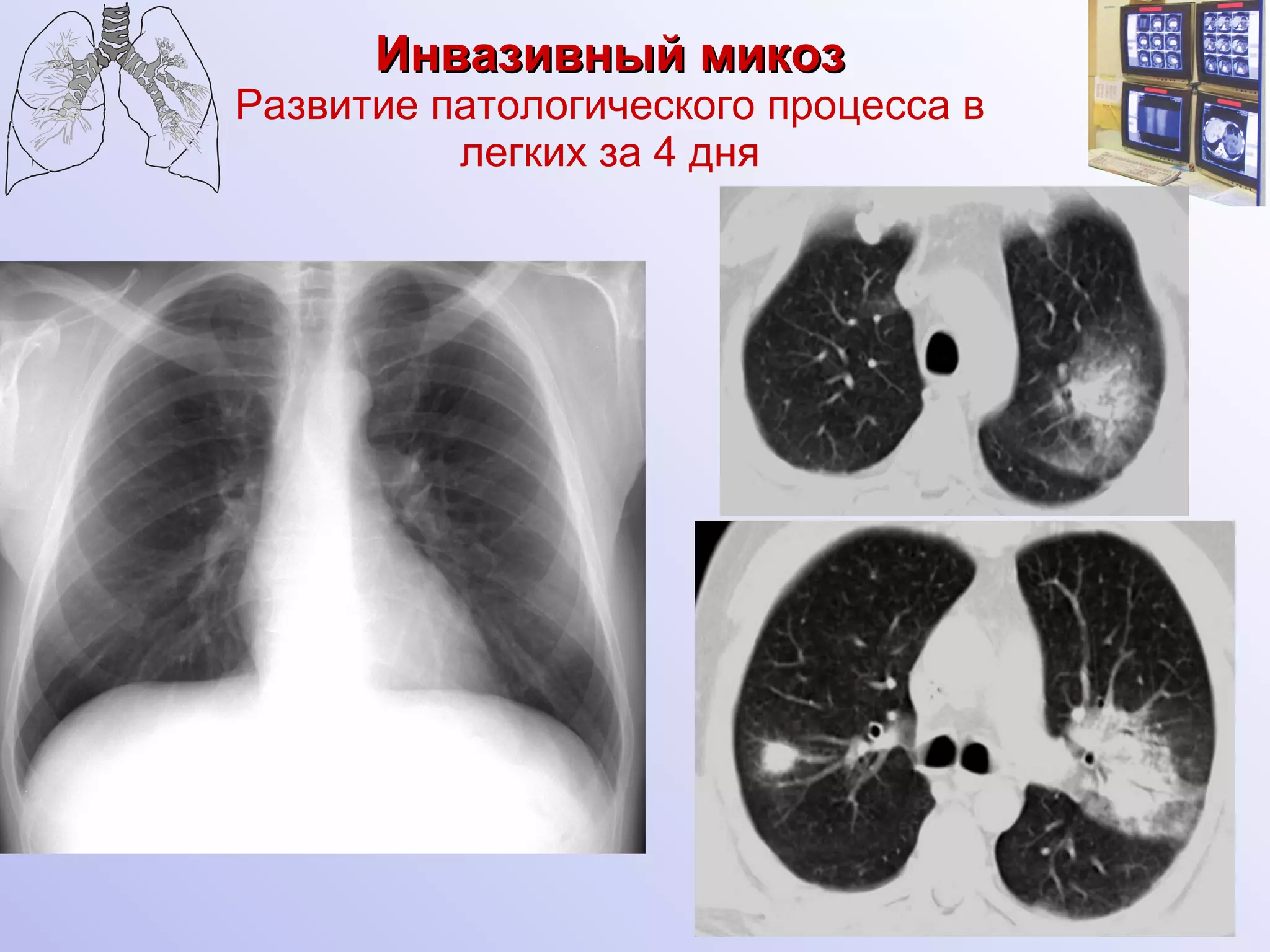 Инвазивный микоз Развитие патологического процесса в легких за 4 дня Ершов 