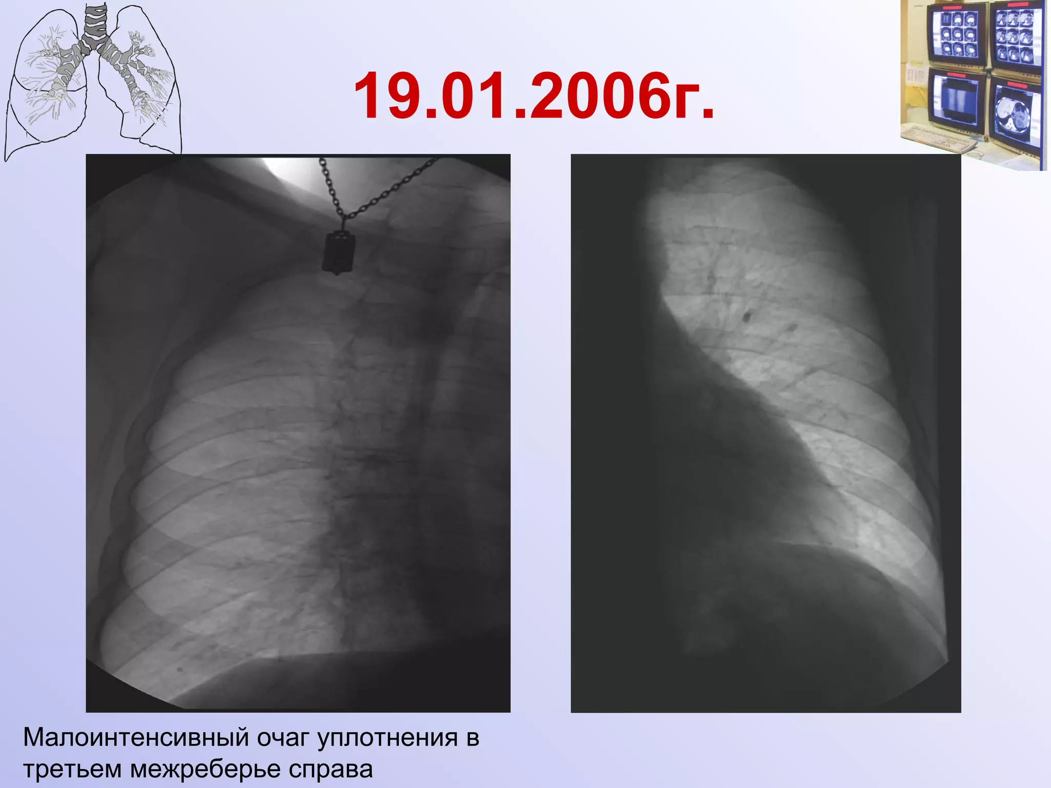 19.01.2006г. Малоинтенсивный очаг уплотнения в третьем межреберье справа 