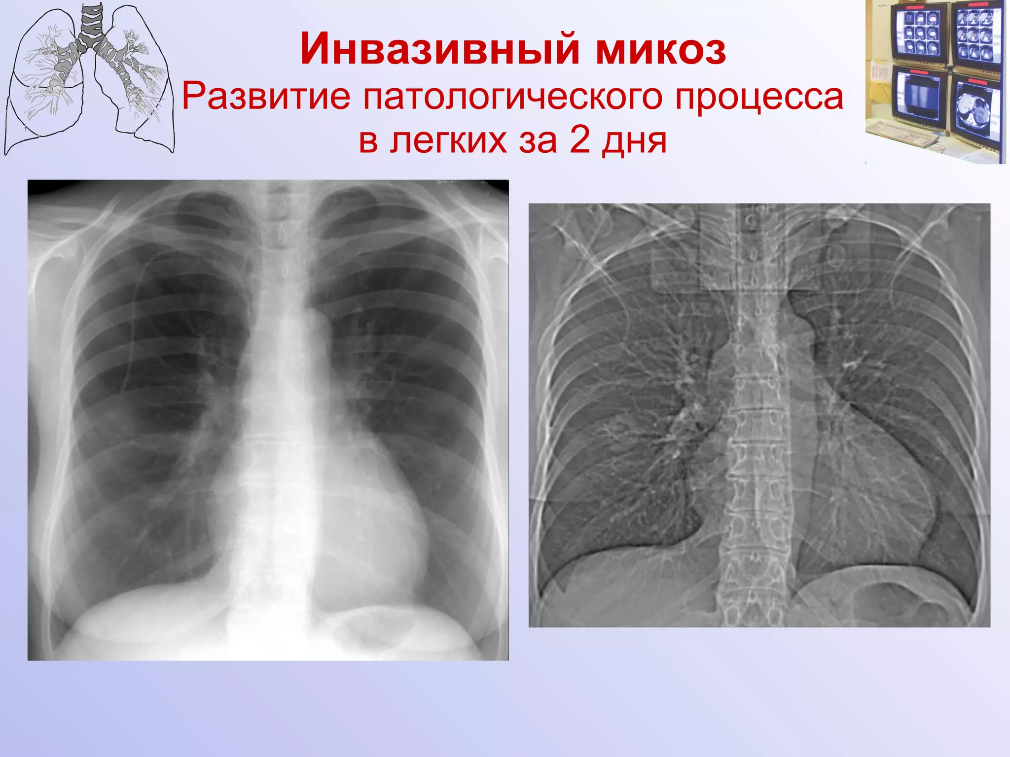 Инвазивный микоз Развитие патологического процесса в легких за 2 дня Киприянова 
