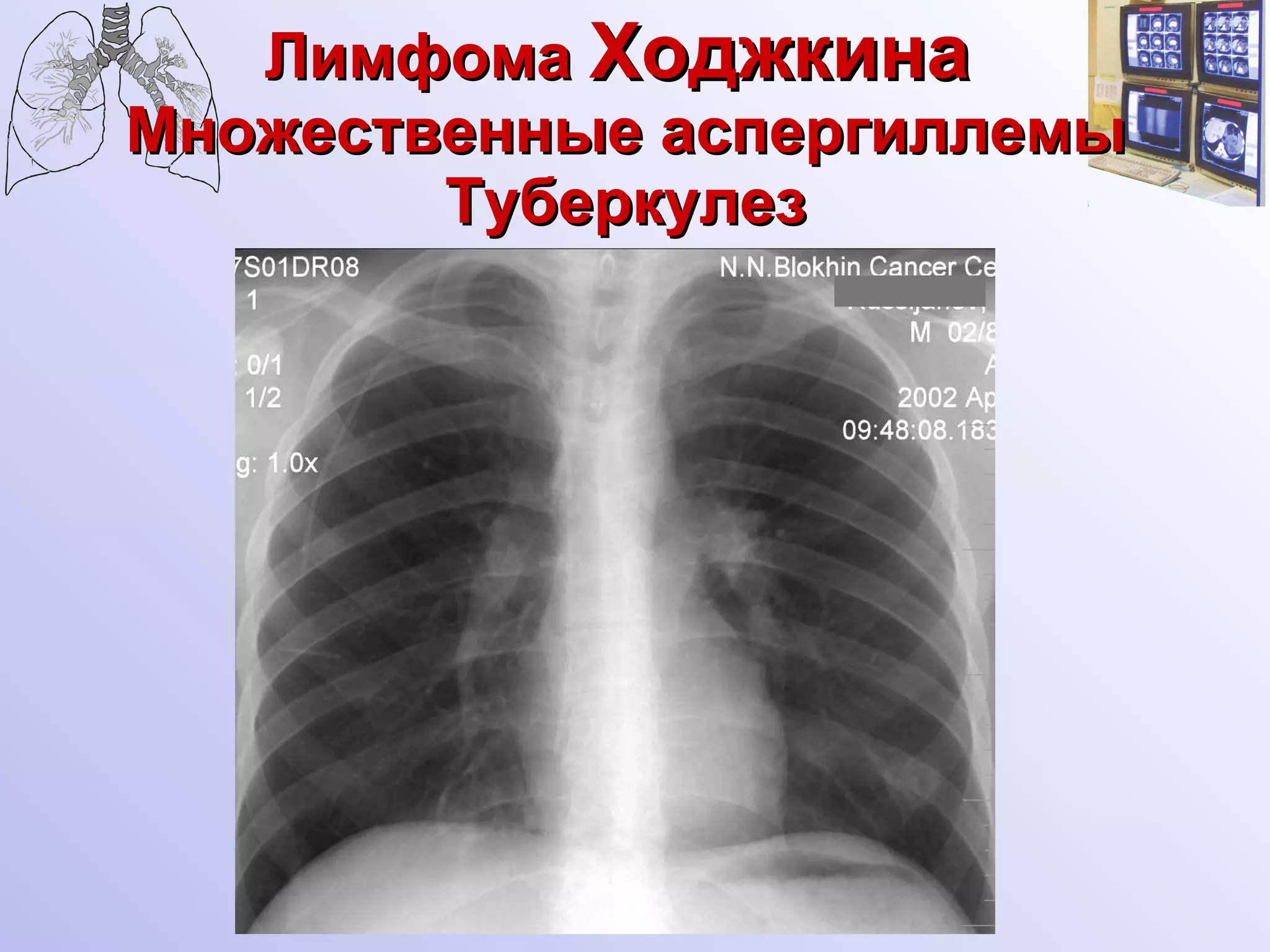 Лимфома  Ходжкина   Множественные аспергиллемы Туберкулез 