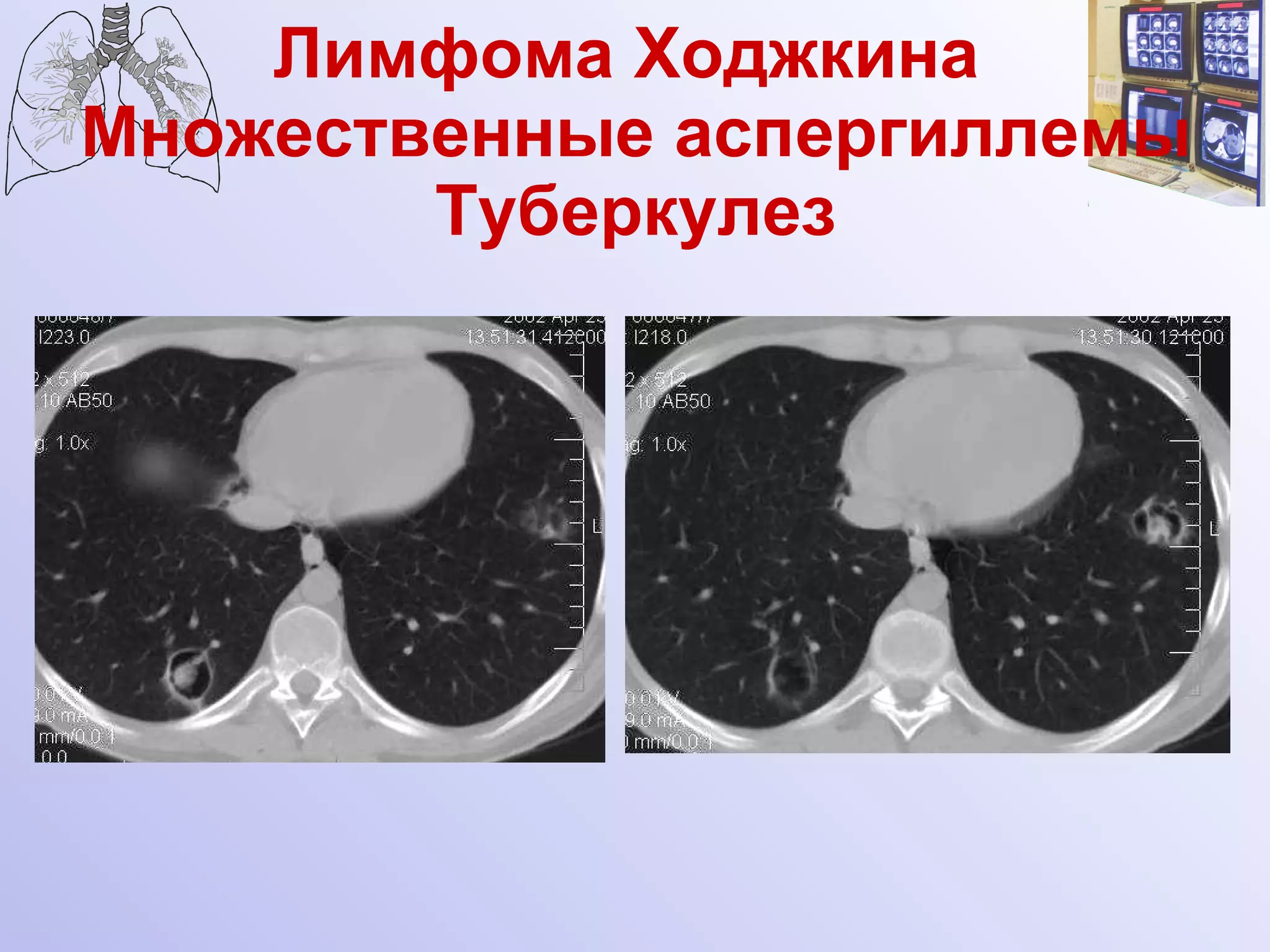 Лимфома Ходжкина  Множественные аспергиллемы Туберкулез 