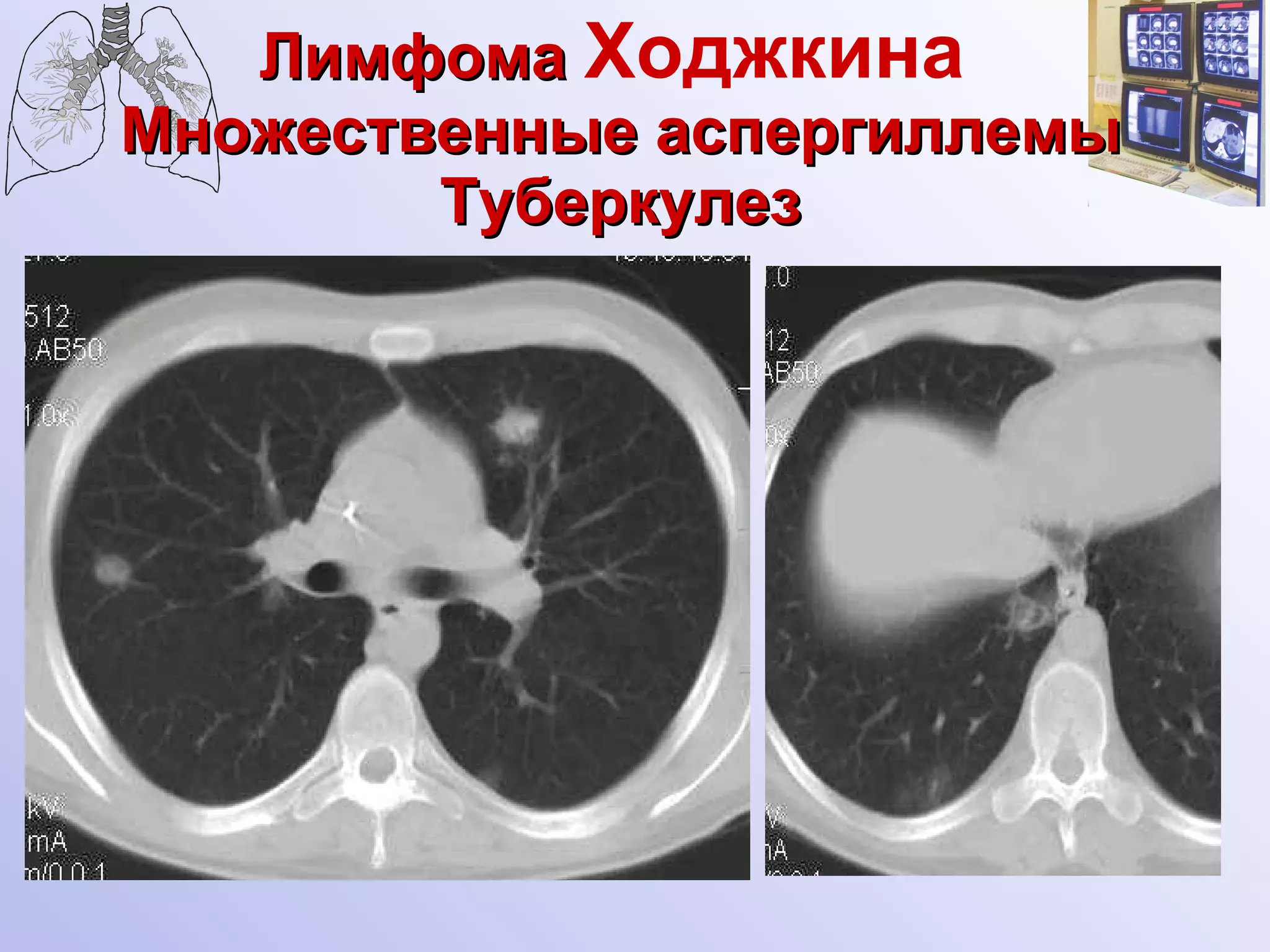 Лимфома  Ходжкина   Множественные аспергиллемы Туберкулез 