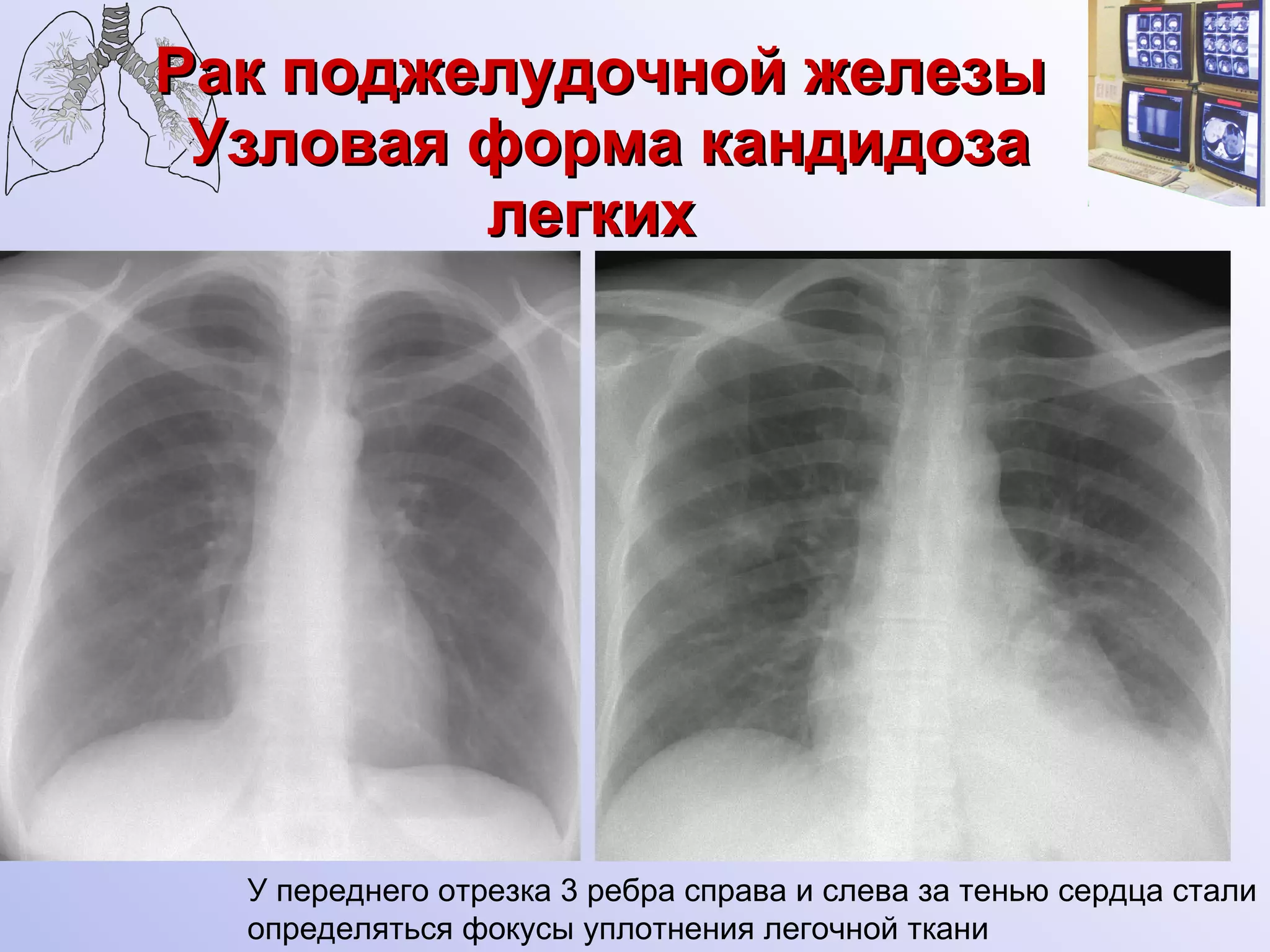 Рак поджелудочной железы   Узловая форма кандидоза легких   У переднего отрезка 3 ребра справа и слева за тенью сердца стали определяться фокусы уплотнения легочной ткани 