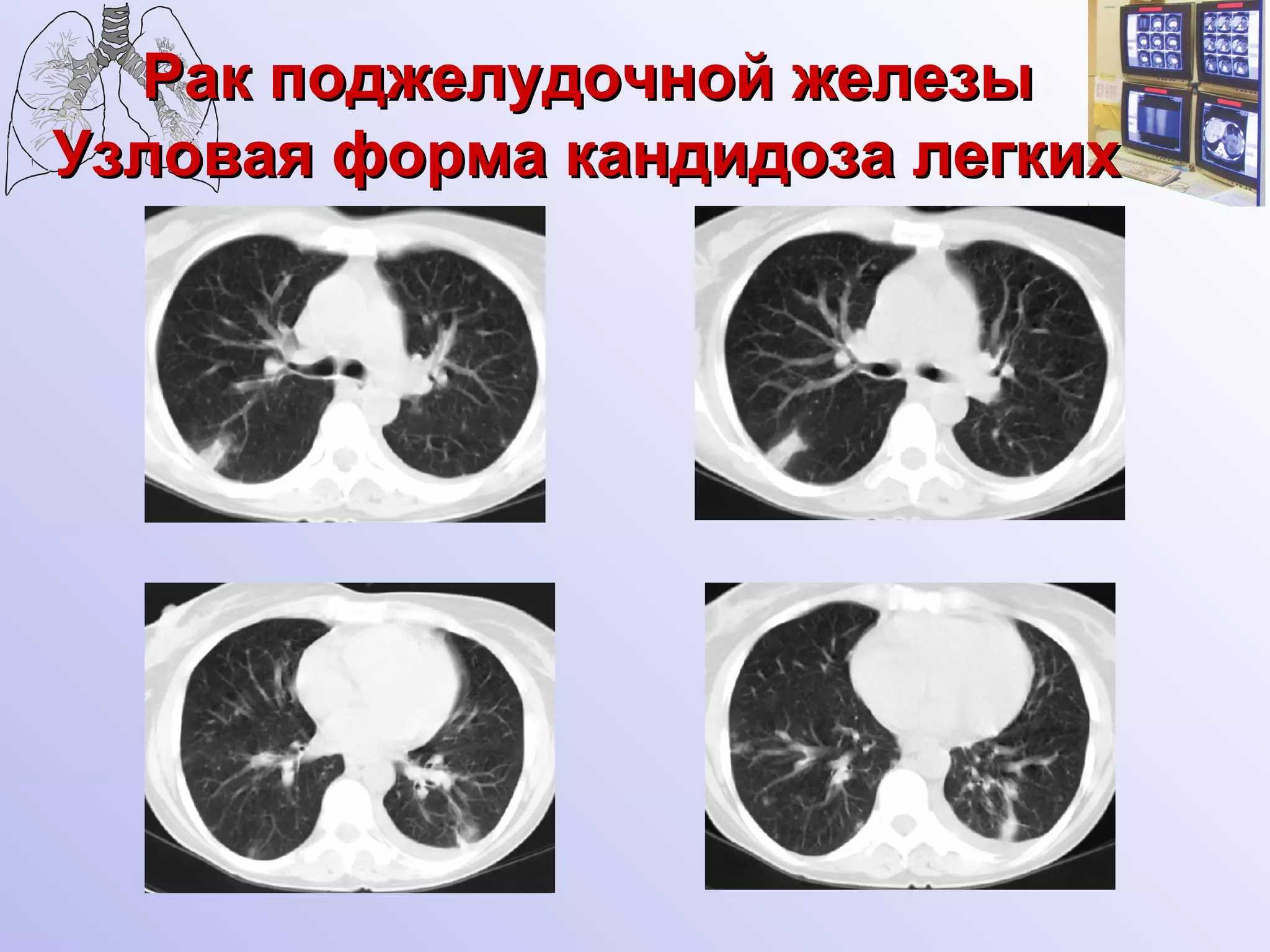 Рак поджелудочной железы   Узловая форма кандидоза легких   