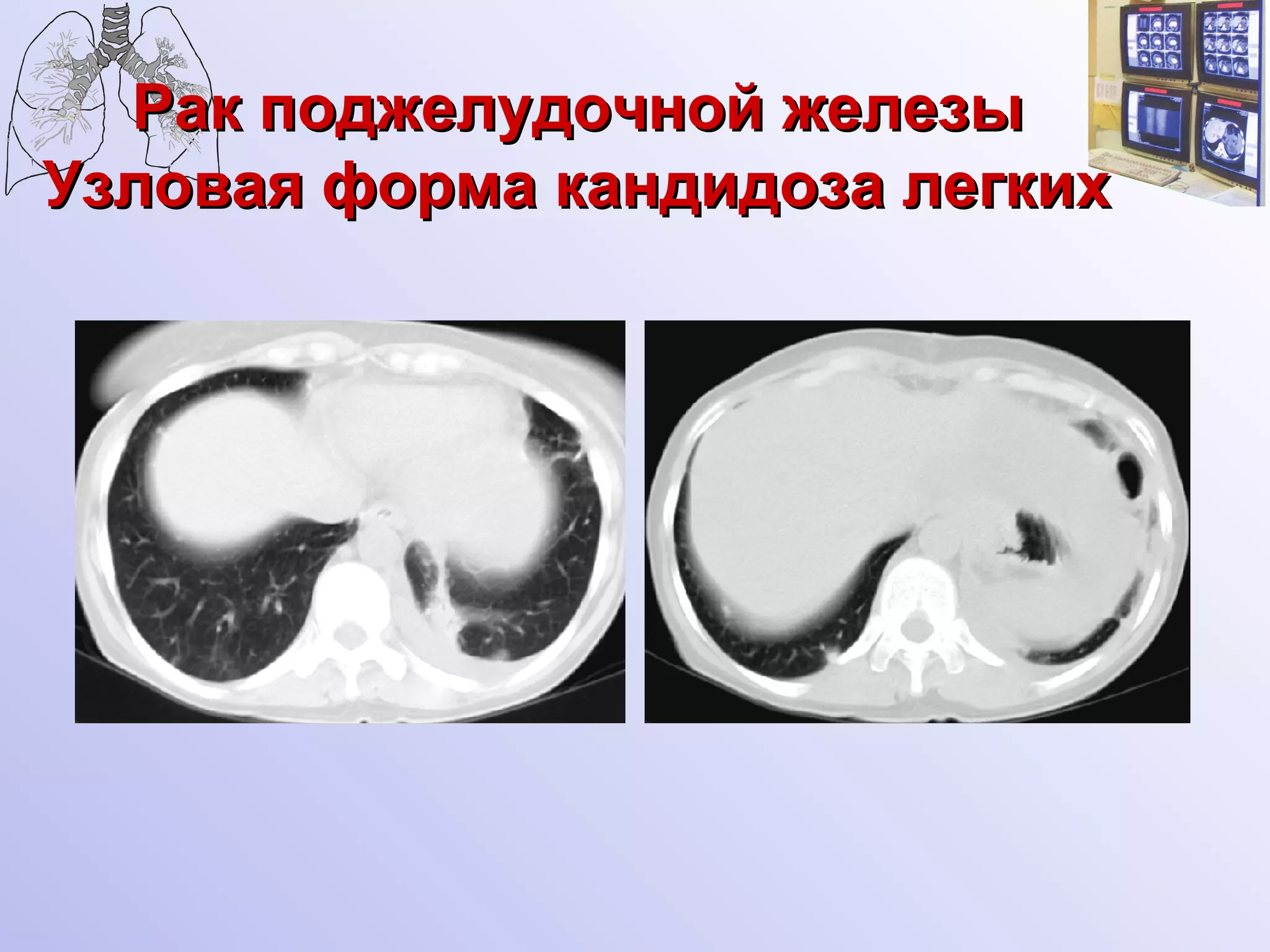 Рак поджелудочной железы   Узловая форма кандидоза легких   