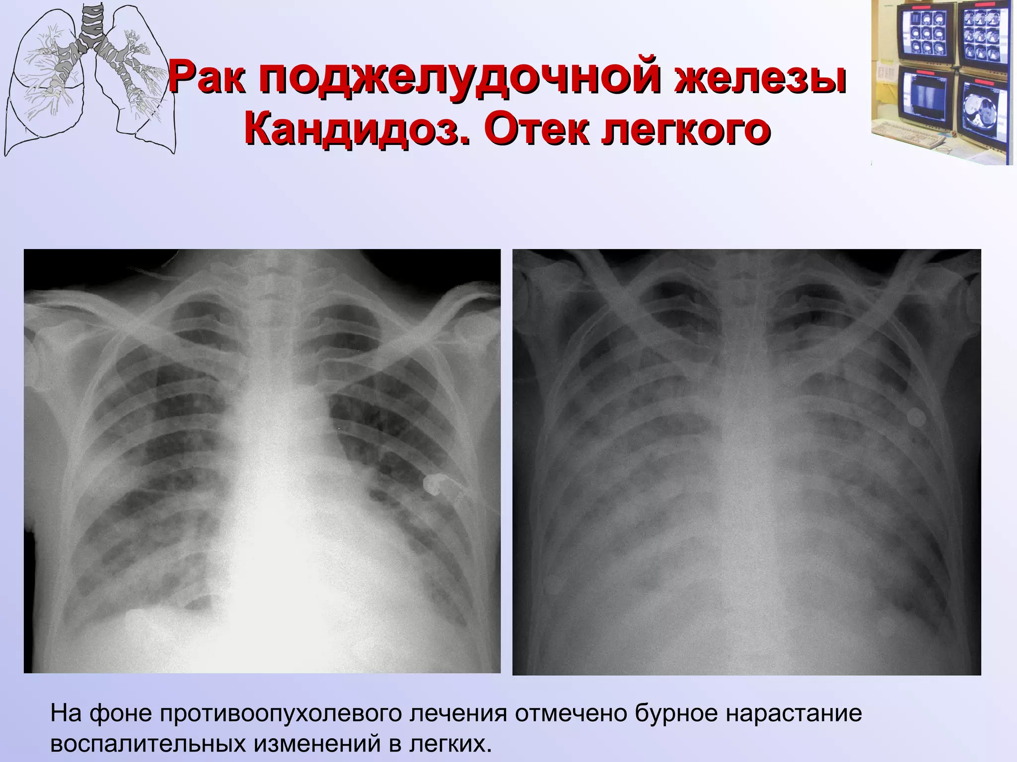 Рак  поджелудочной  железы Кандидоз. Отек легкого На фоне противоопухолевого лечения отмечено бурное нарастание воспалительных изменений в легких. 