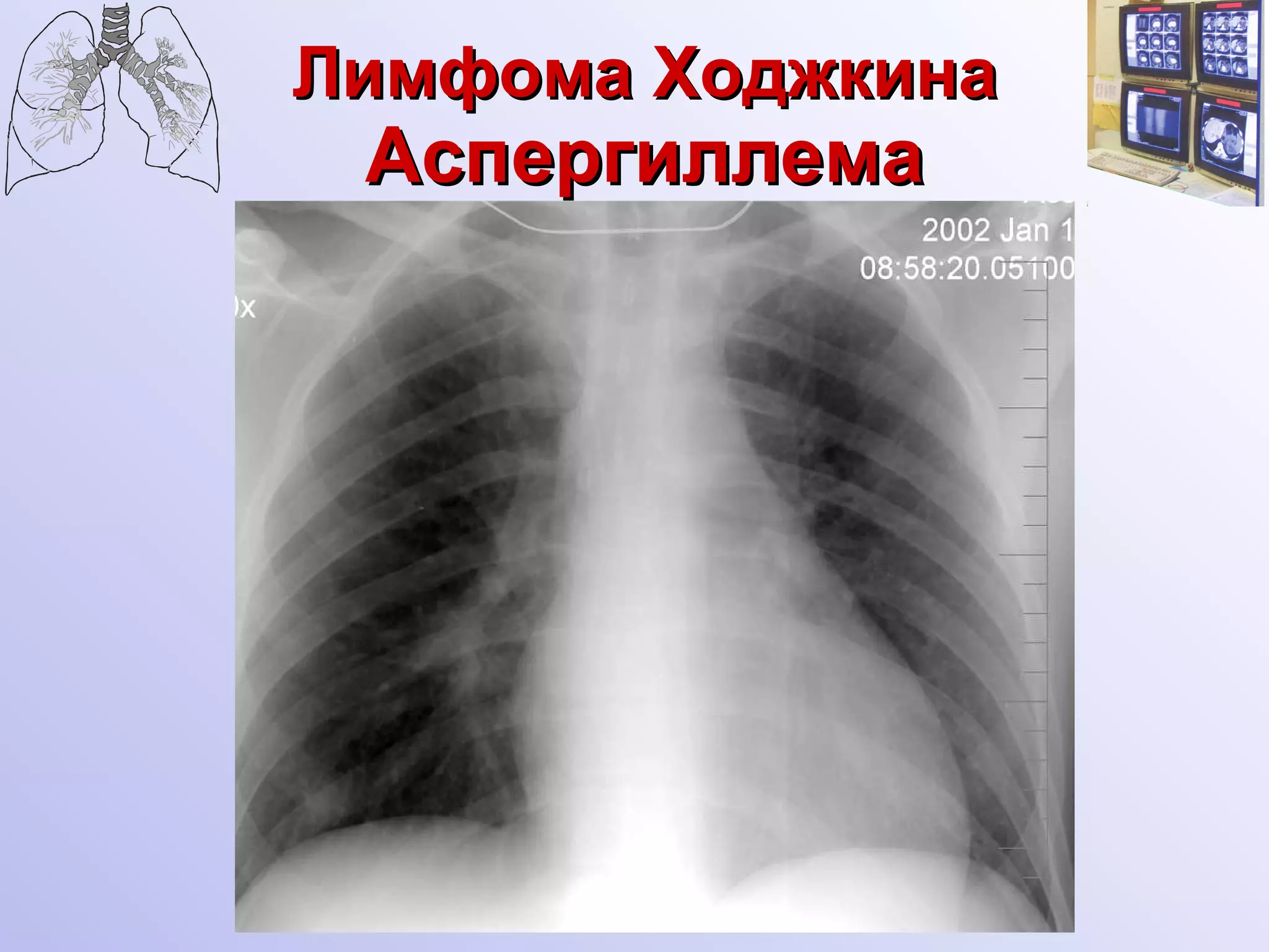 Лимфома Ходжкина  Аспергиллема 