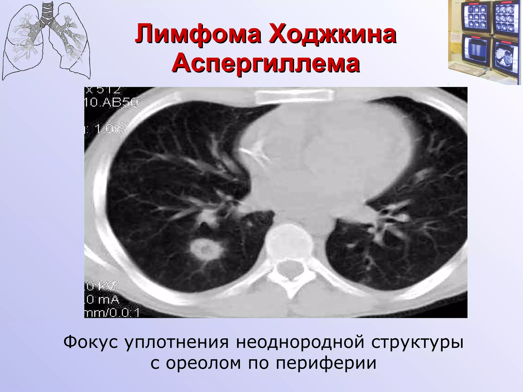 Лимфома Ходжкина Аспергиллема Фокус уплотнения неоднородной структуры с ореолом по периферии 