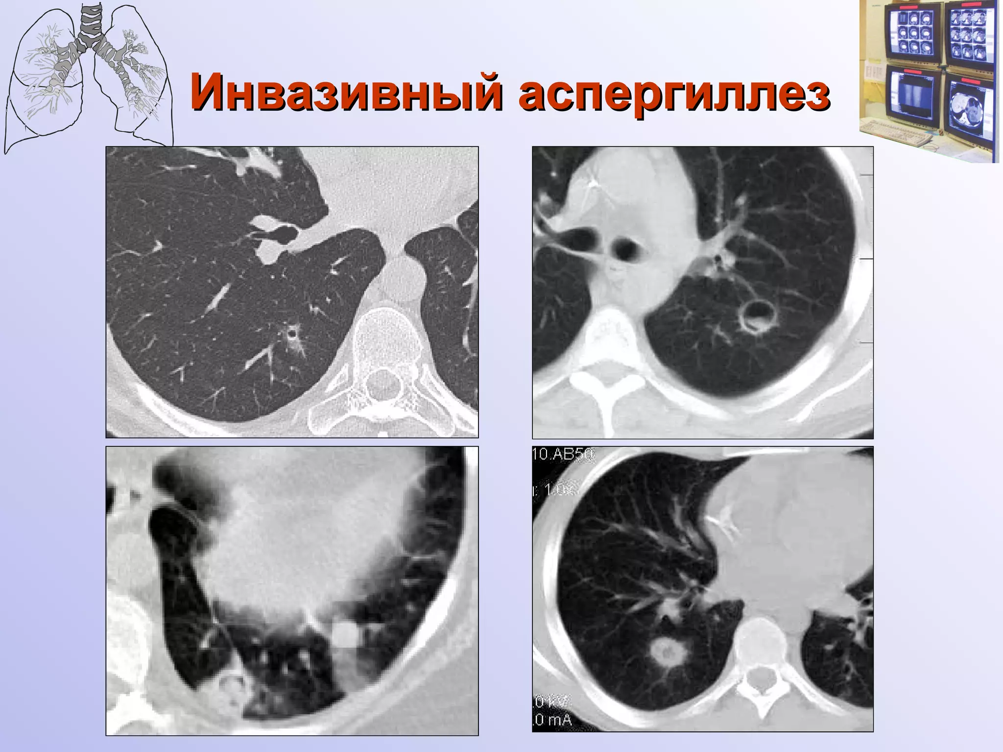 Инвазивный аспергиллез 